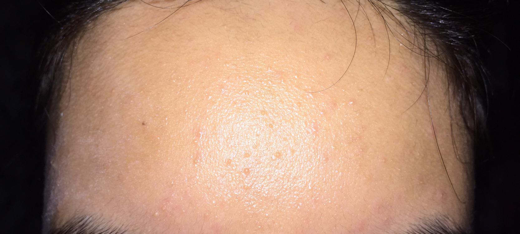 The bumps on my forehead started to grow once i started to apply