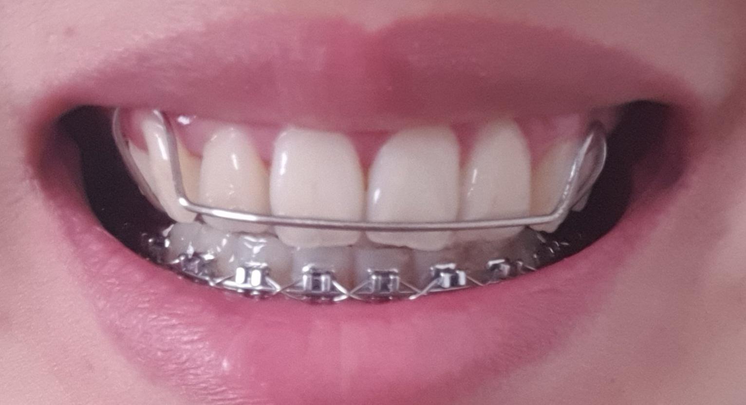 Are Hawley retainers supposed to fit his low? I've met 2 different