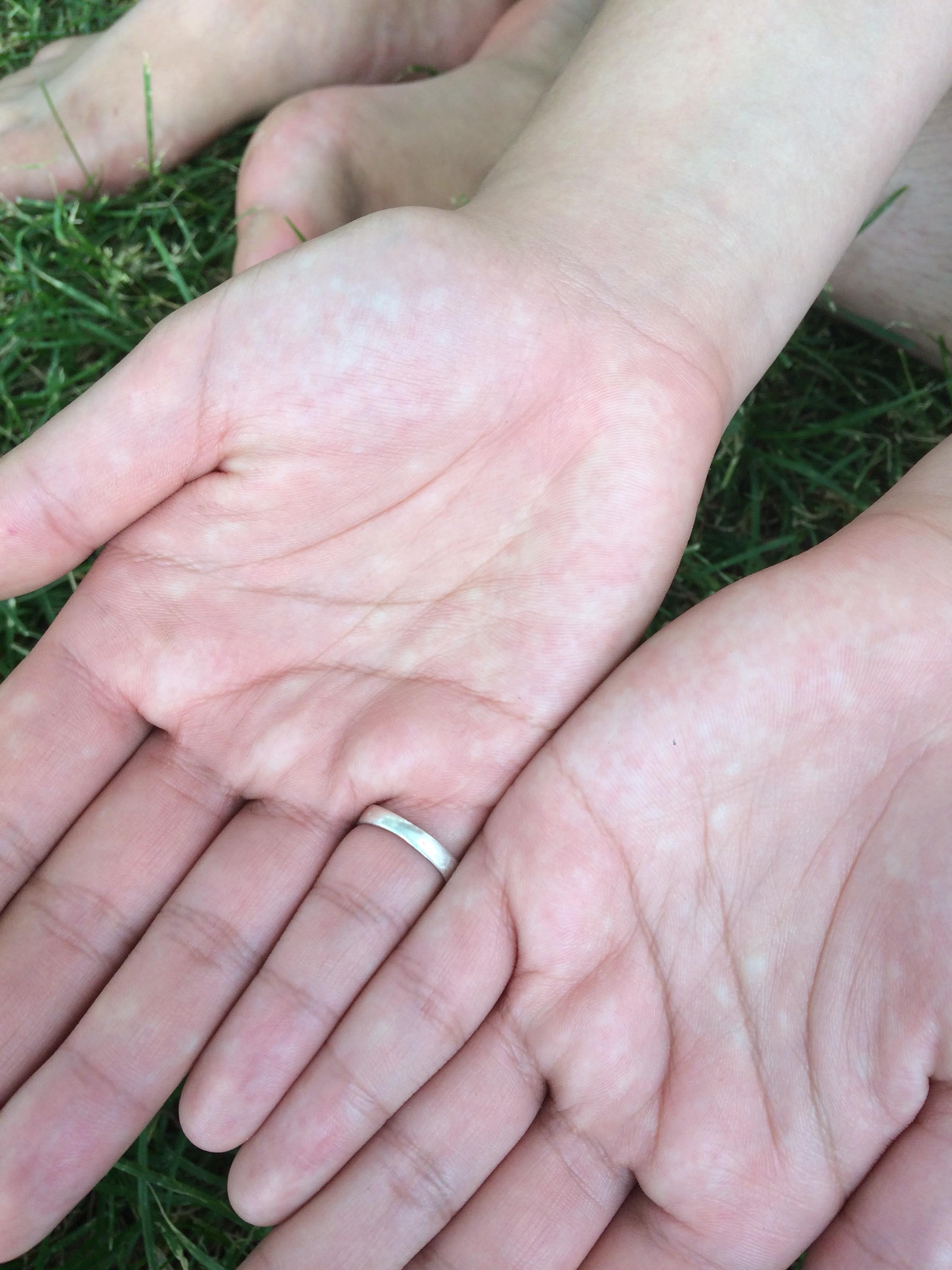 White Dots On Hands While Under Lsd : R/Lsd