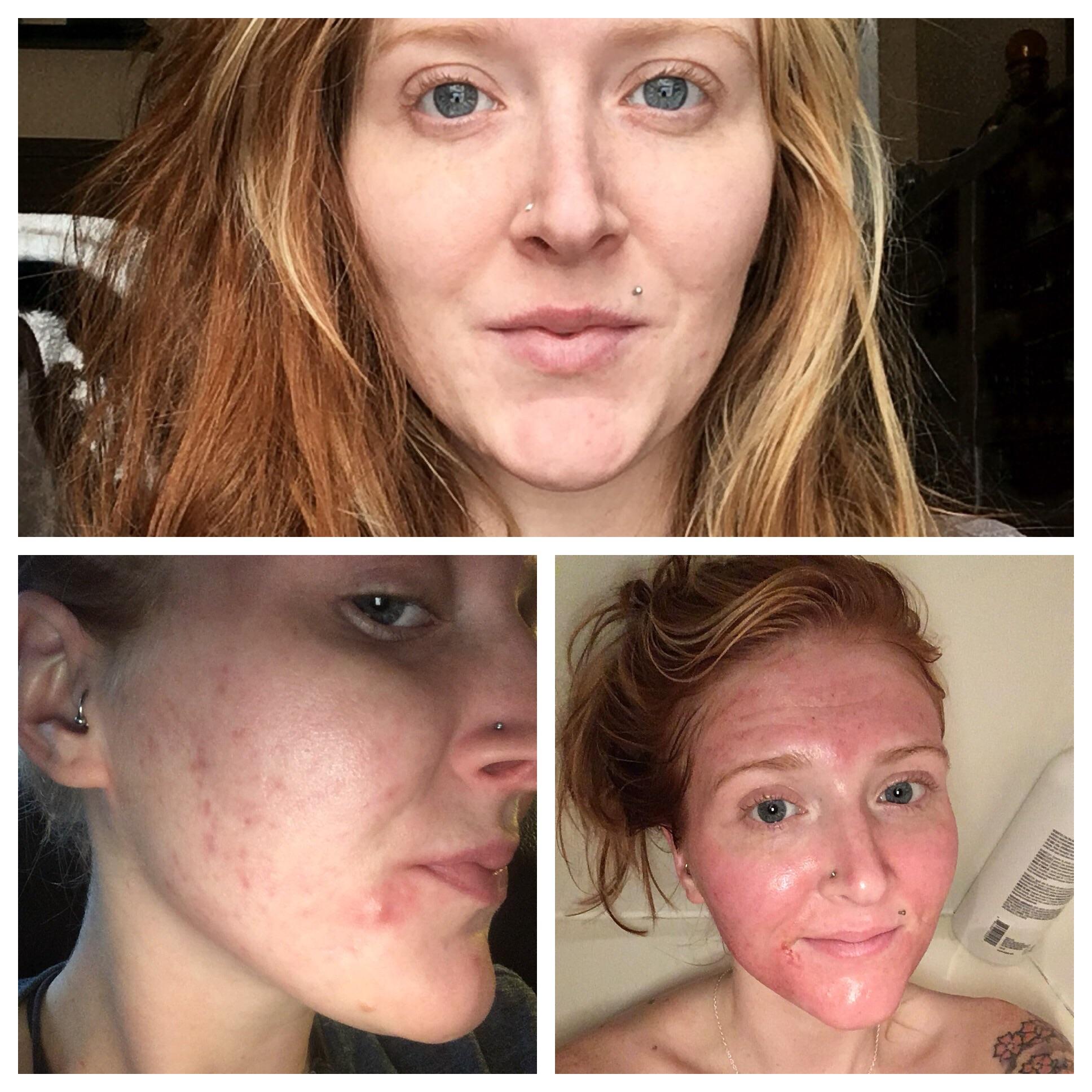 Turned 26 and became a victim of cystic acne due to a hormonal