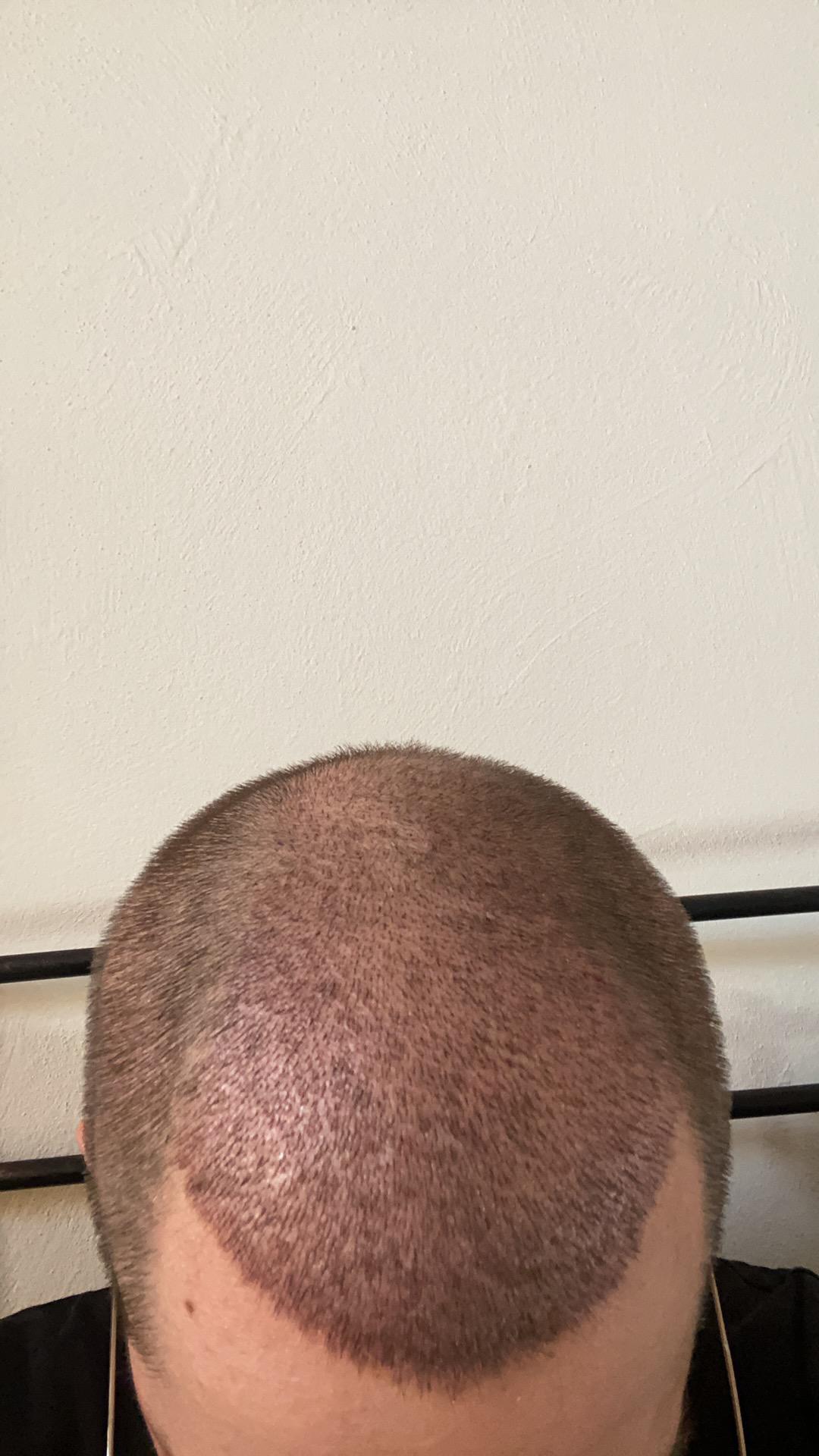 Hair transplant without taking finasteride? HairTransplants