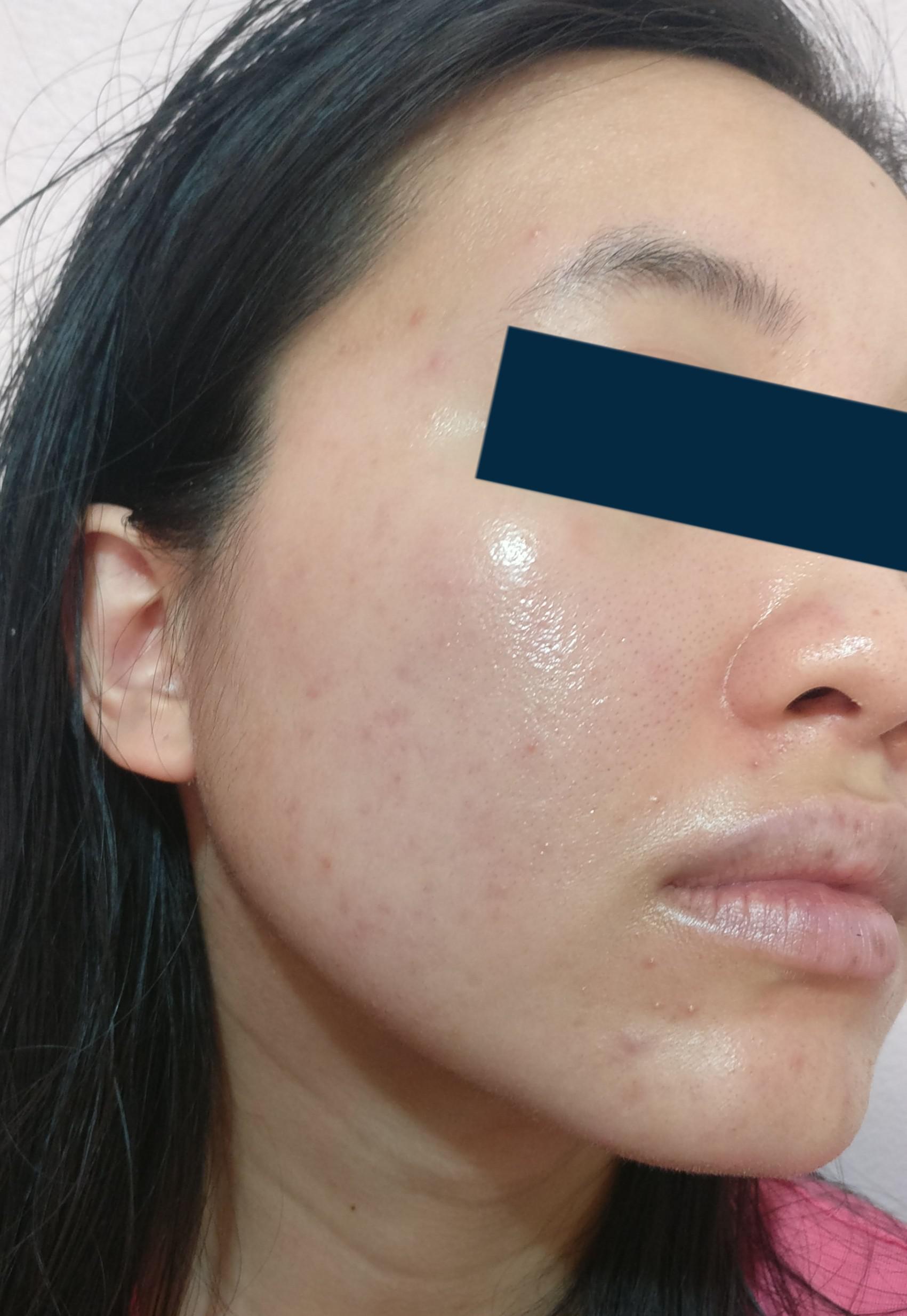 Fungal acne and acne scars, help with fixing skincare routine? r
