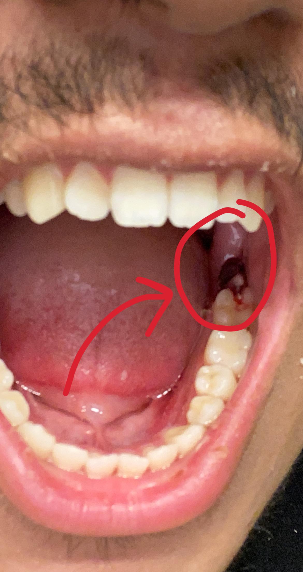 Day 2 post wisdom teeth removal. Anyone know what this is? It’s kind of touching my molar. If it