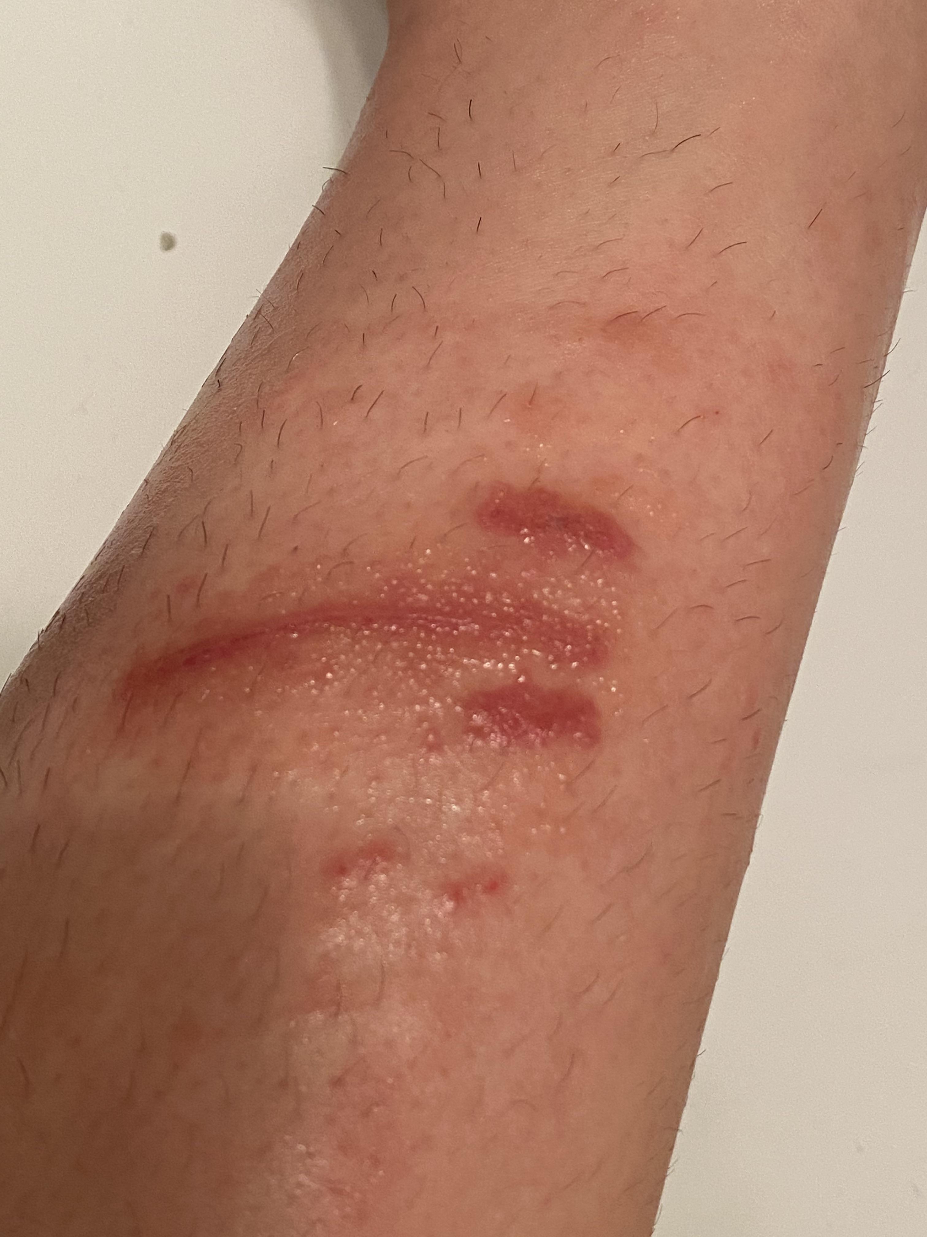 on antibiotics for a skin infection on cut but i think i’m having an