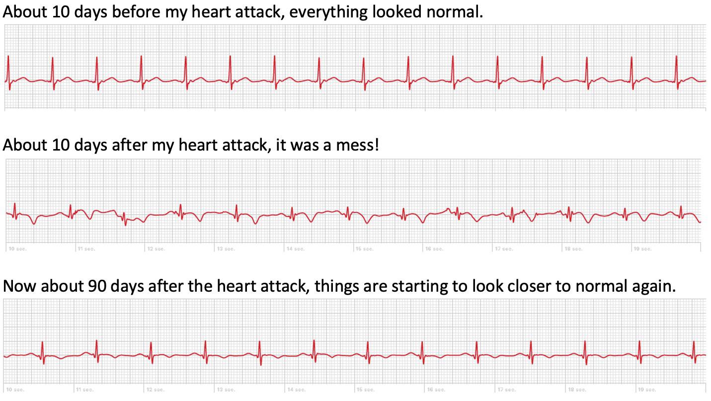 PVC on Kardia reading? r/PVCs