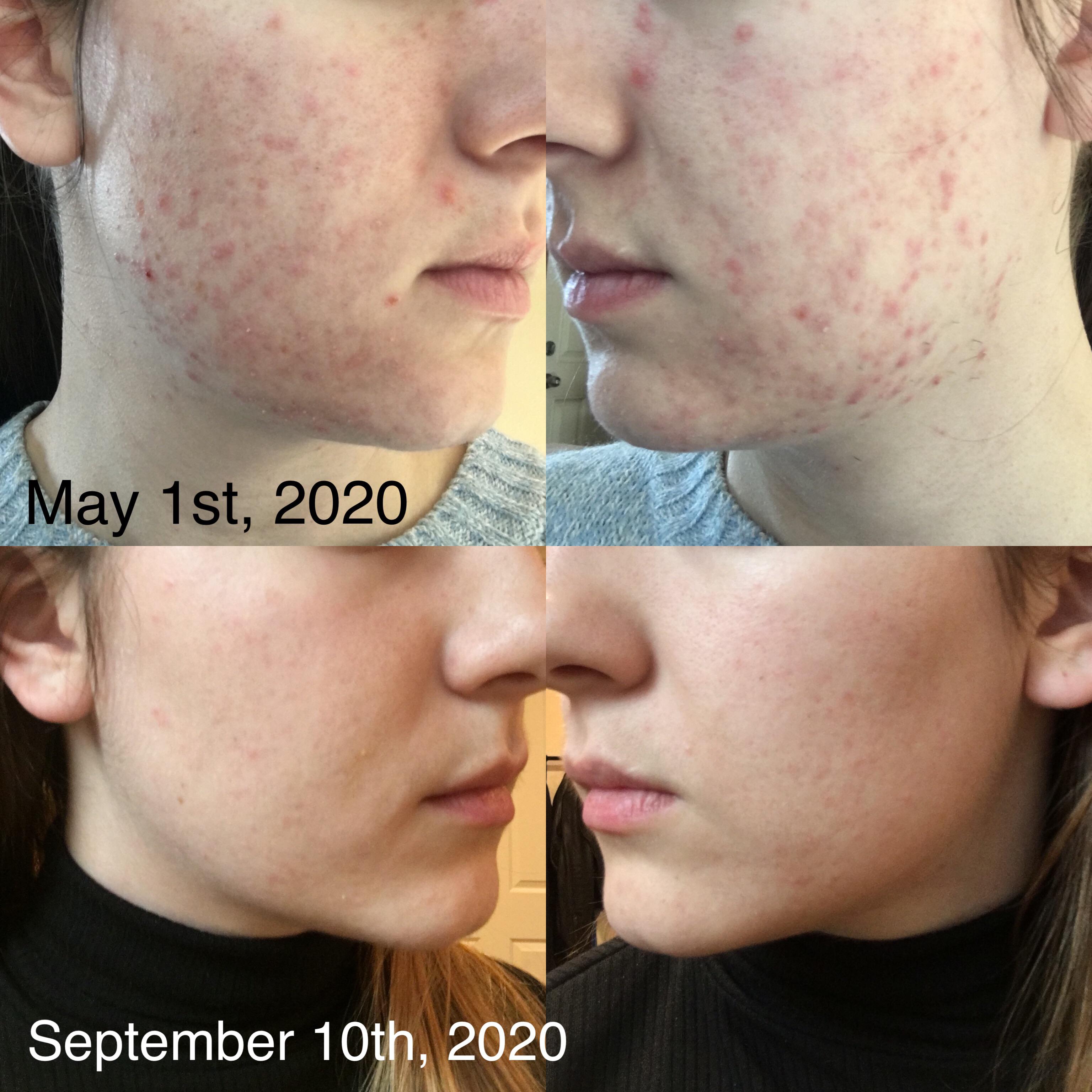 [B&A] Transformed my skin with a cruelty free routine. The first time I