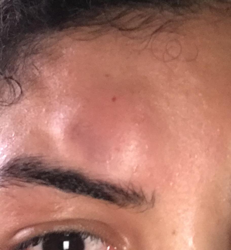 Best way to treat this bump? : r/medical_advice