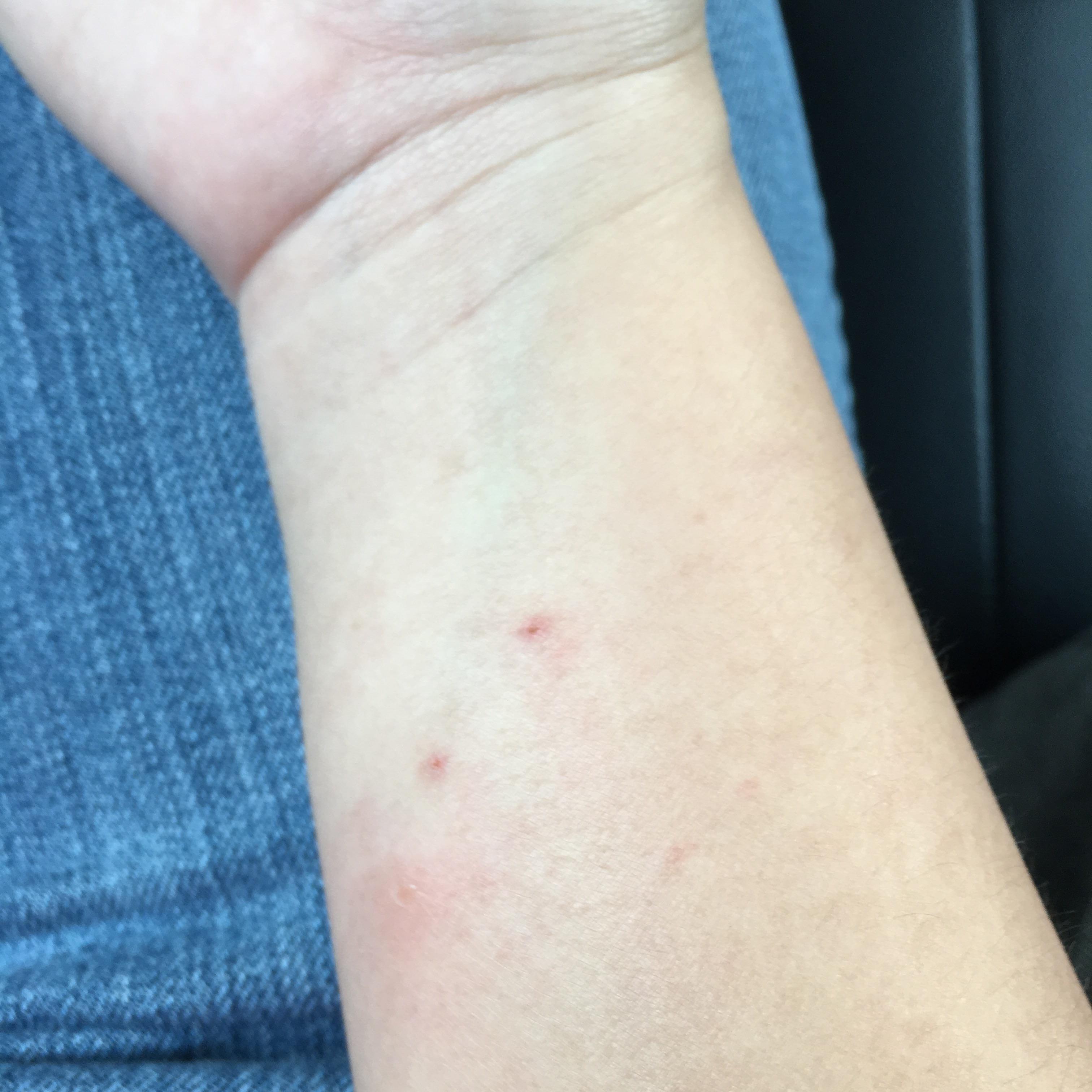 Mosquito bites that looks like snake bite. r/mildlyinteresting