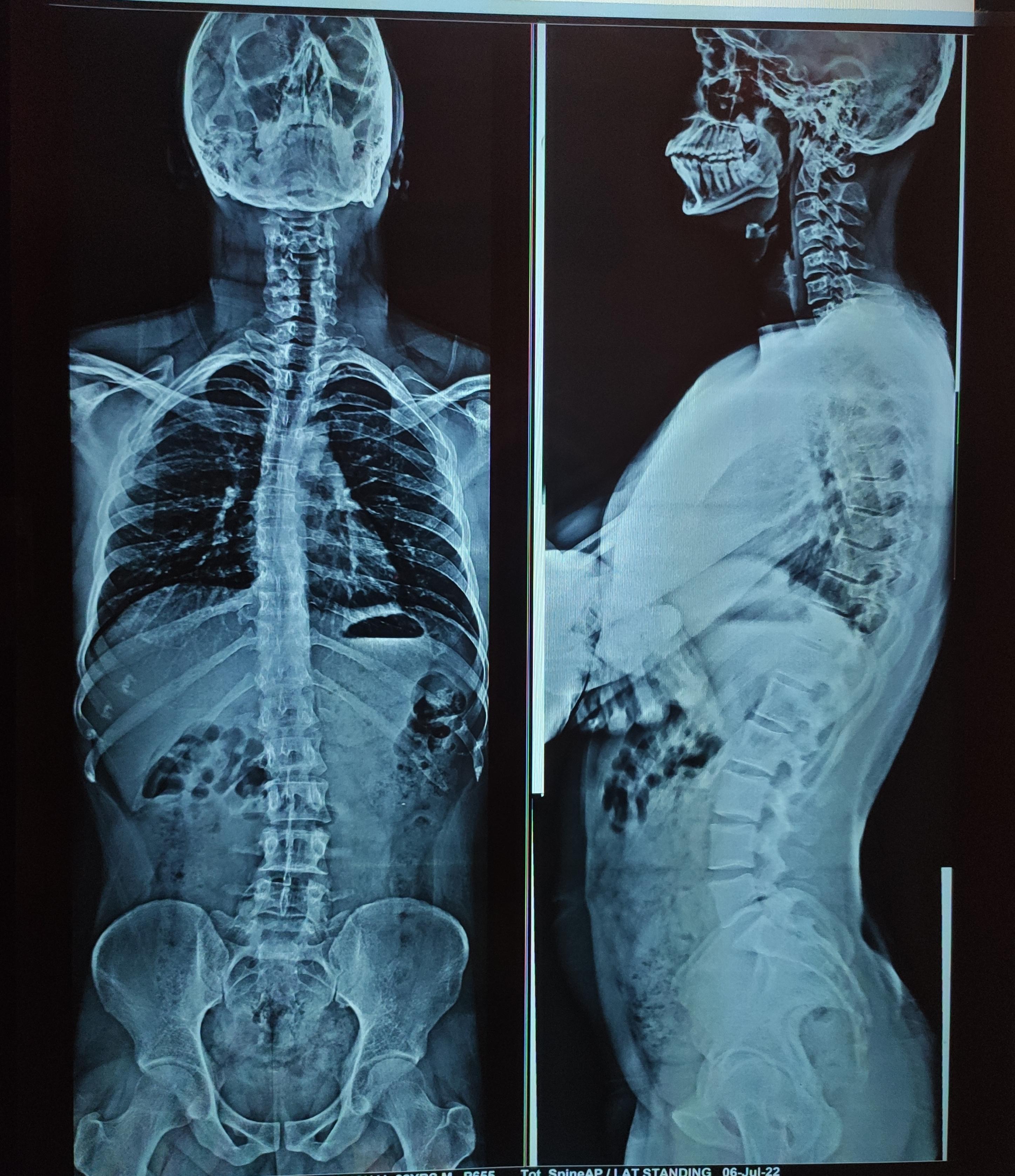 Is it a major scoliosis ?. Can i do heavy weightlifting with that much