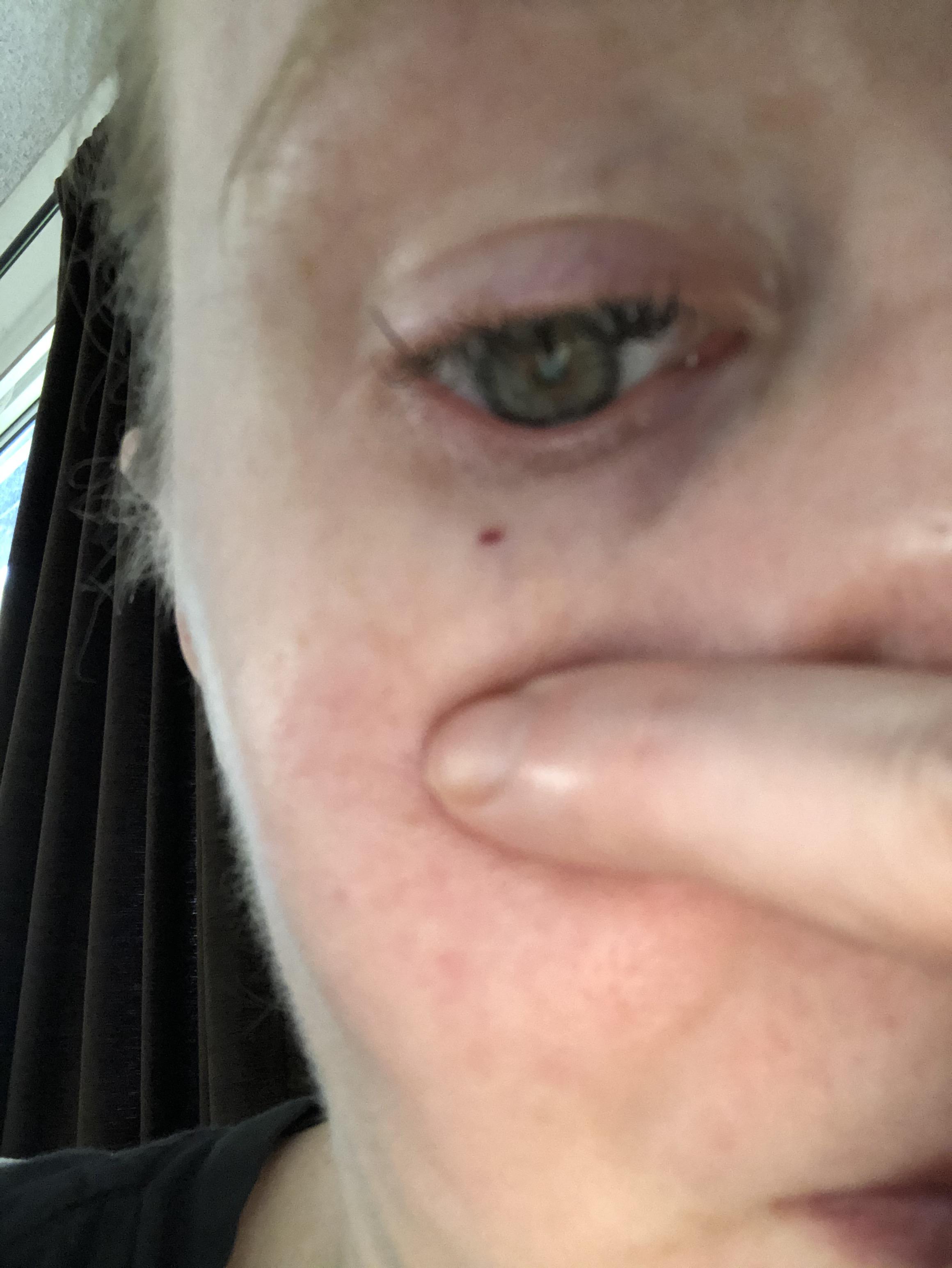 [Skin Concern] sudden blood spot appeared!! Randomly what