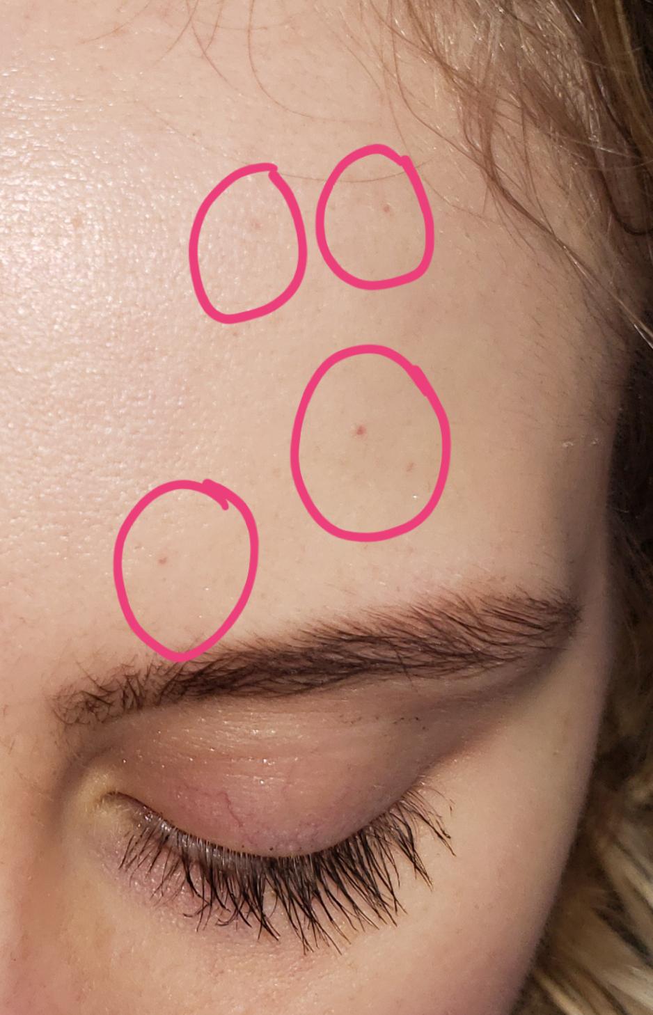 Small red dots starting to appear since starting tret? I use SPF