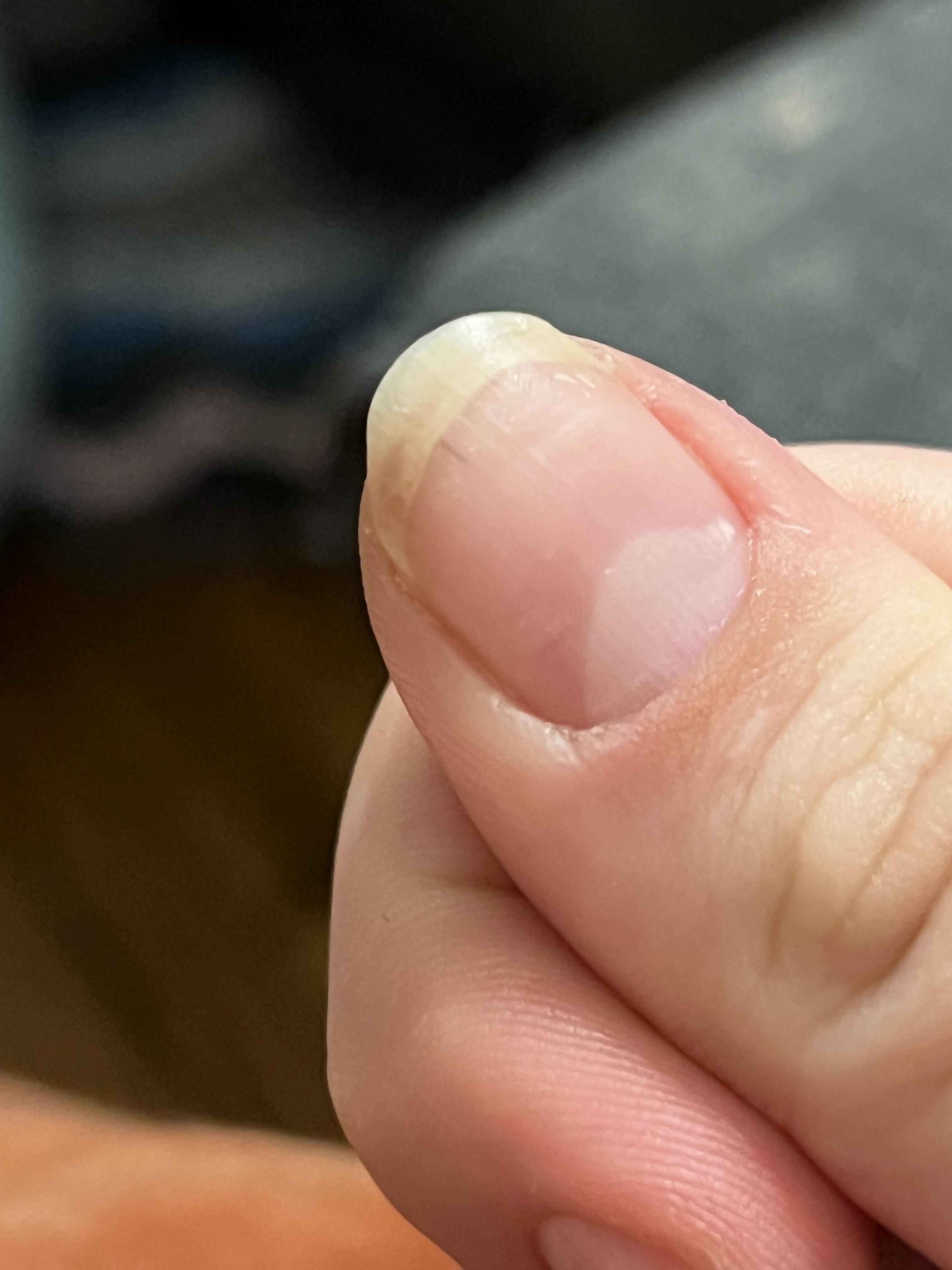 Black line on nail r/Dermatology