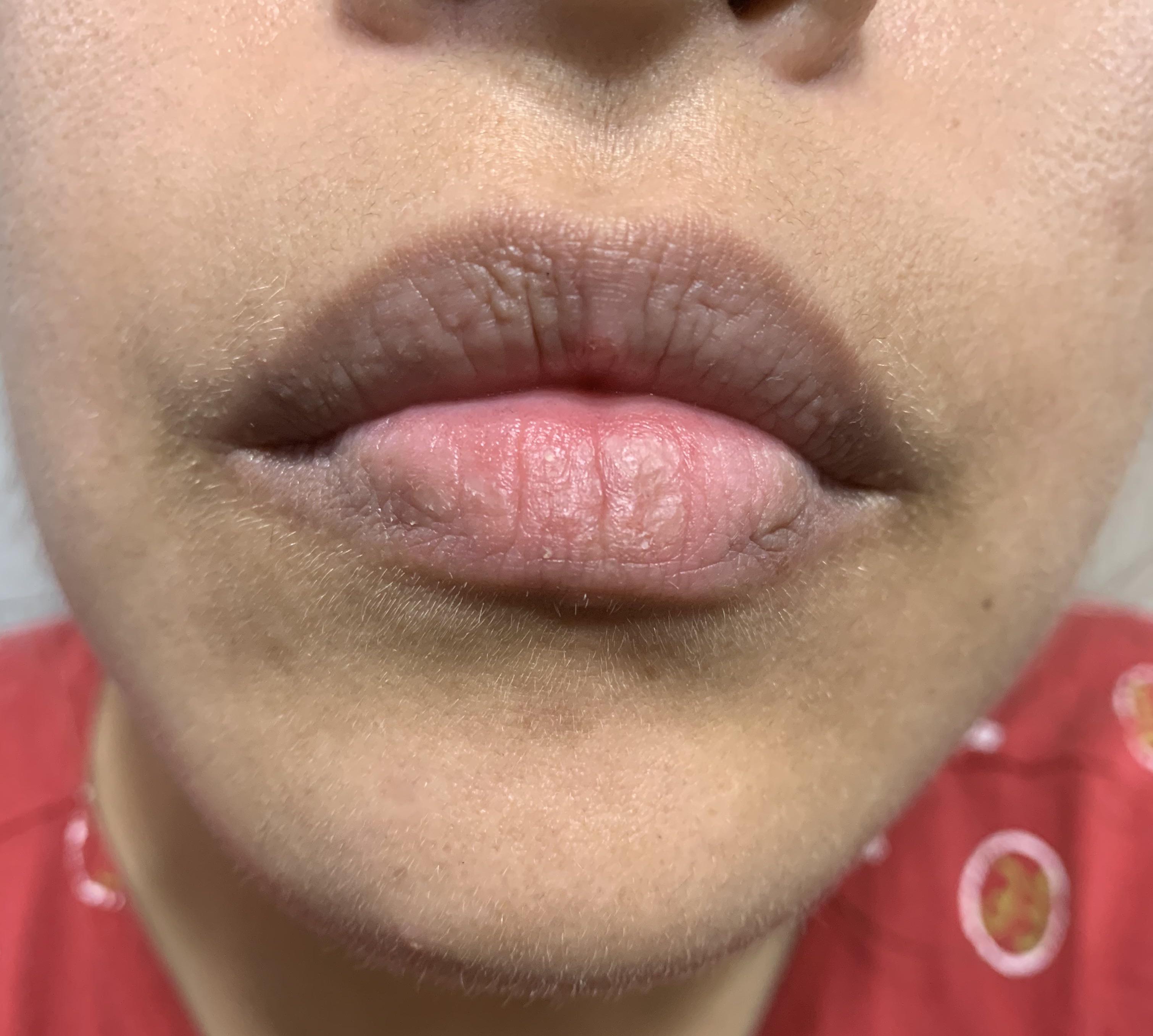 F,32. My lower lip is peeling and sometimes it gets itchy. Started to