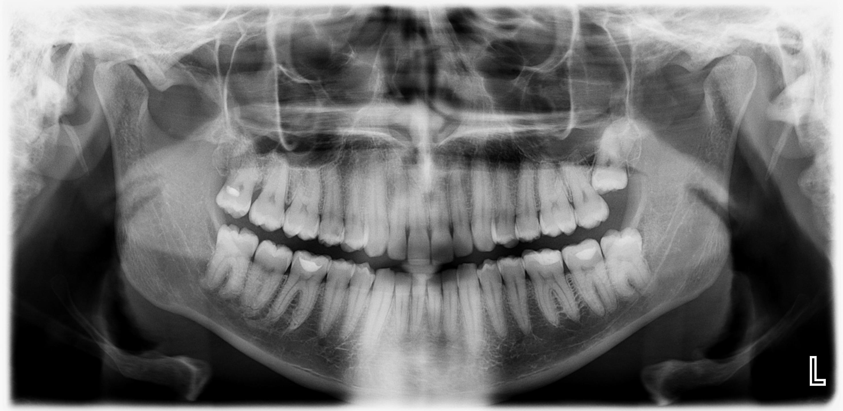 I had my wisdom teeth (lower right side) removed last Friday and since