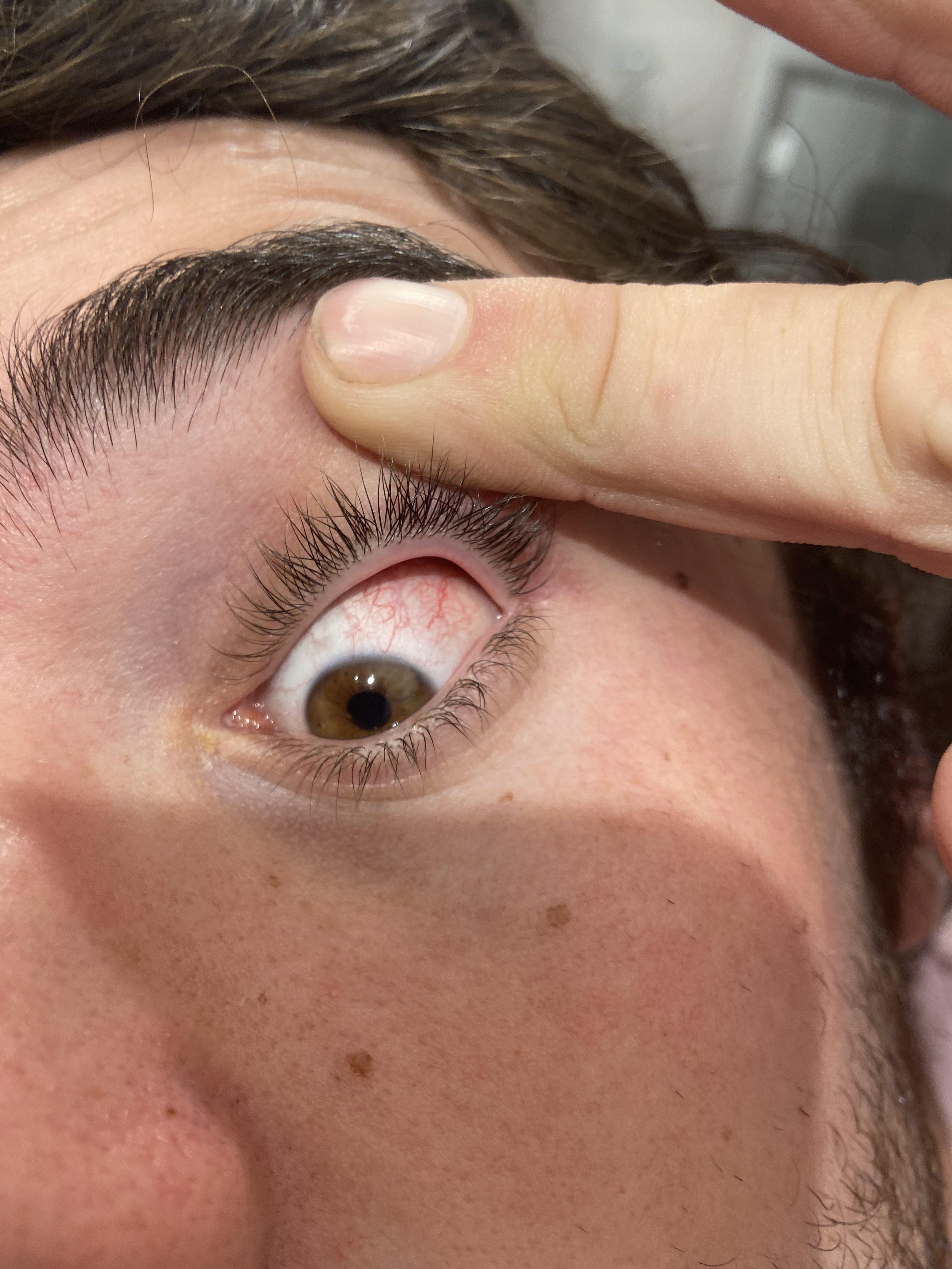 Eye inflammation? Floaters and vs r/Lyme