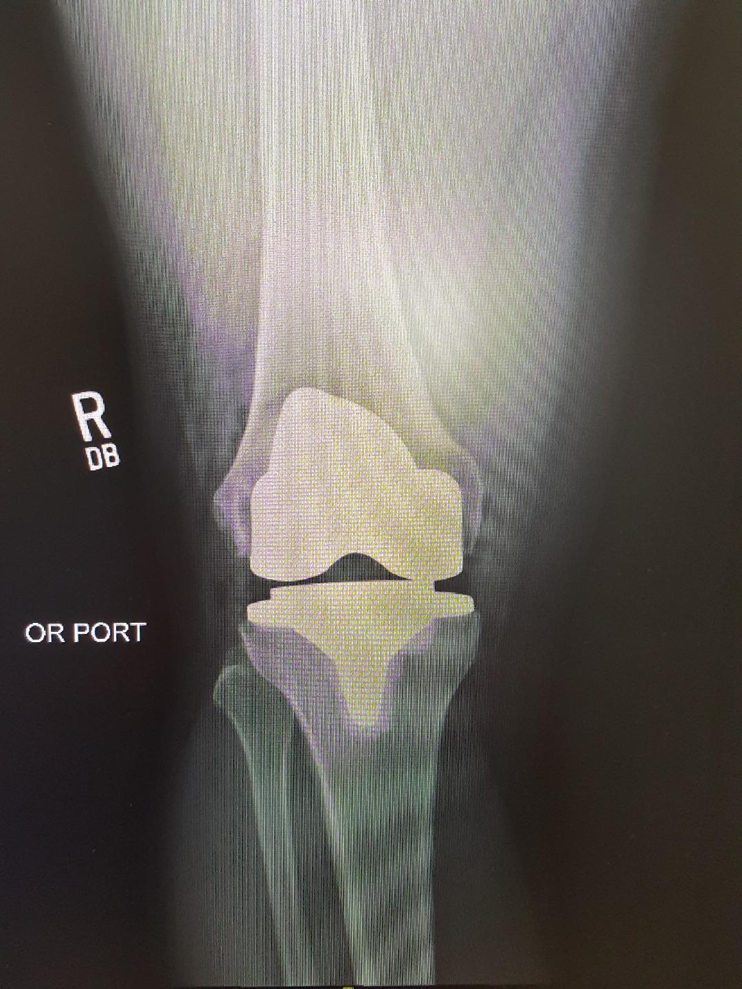 I had a knee replaced today. Arthritis was the cause. Should I see
