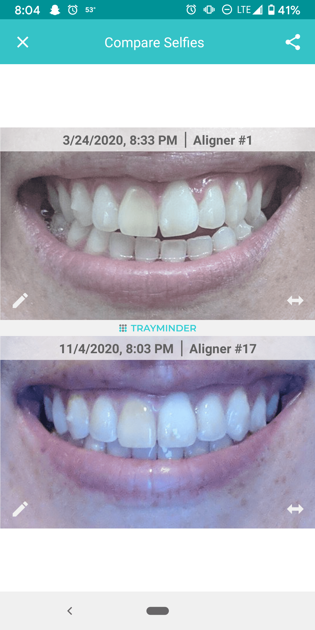 When should i change my invisalign? Explained by FAQ Blog