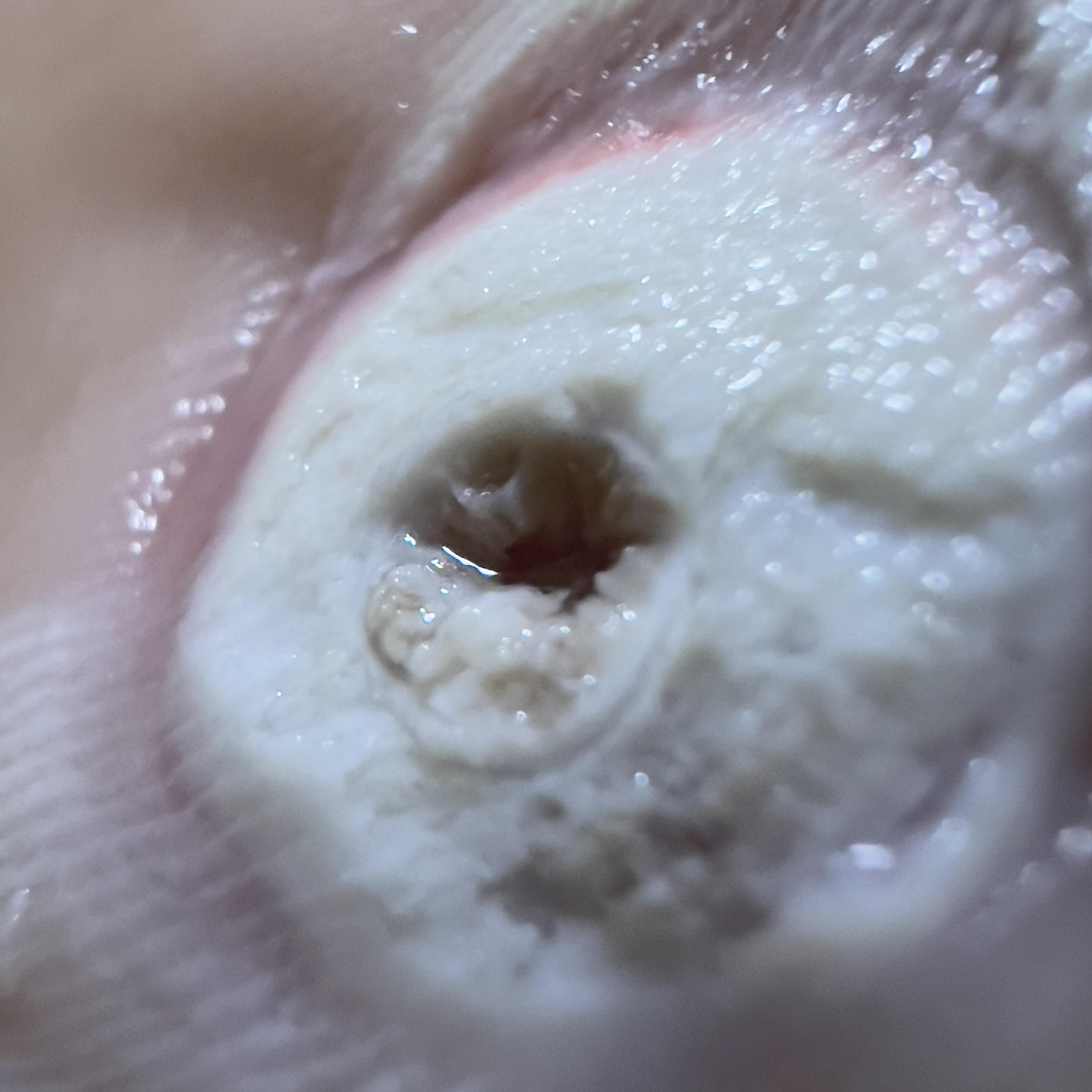 2nd Plantar Wart hole. r/Warts