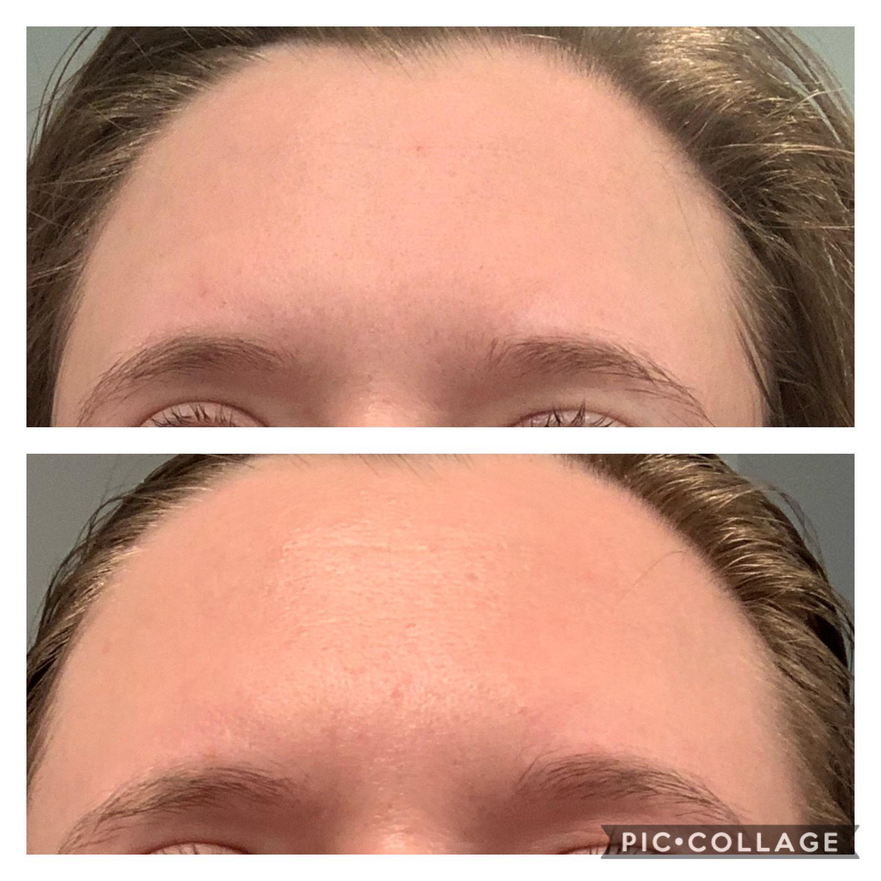 [B&A] 3 months of tret + vitamin C serum r/SkincareAddiction