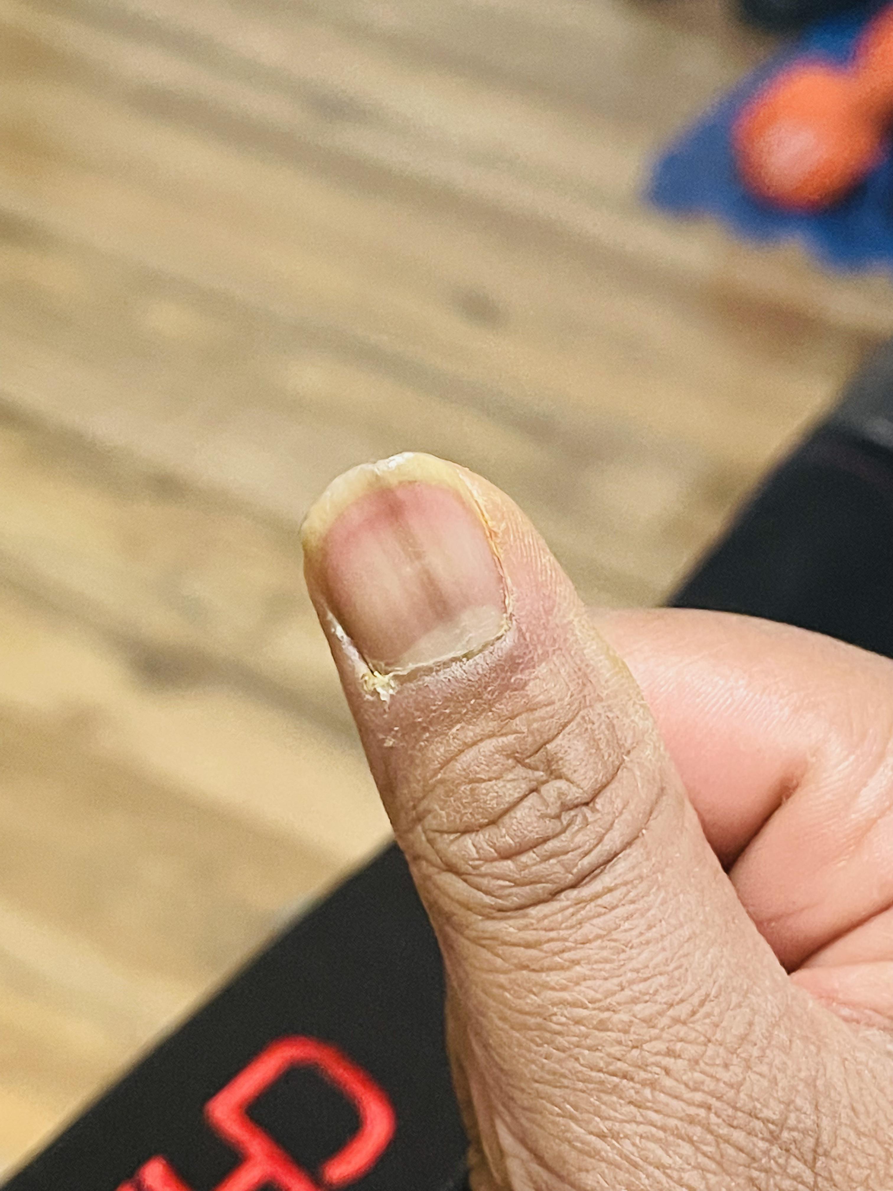 Since reddit is good at diagnosis here is my thumb with a black line on