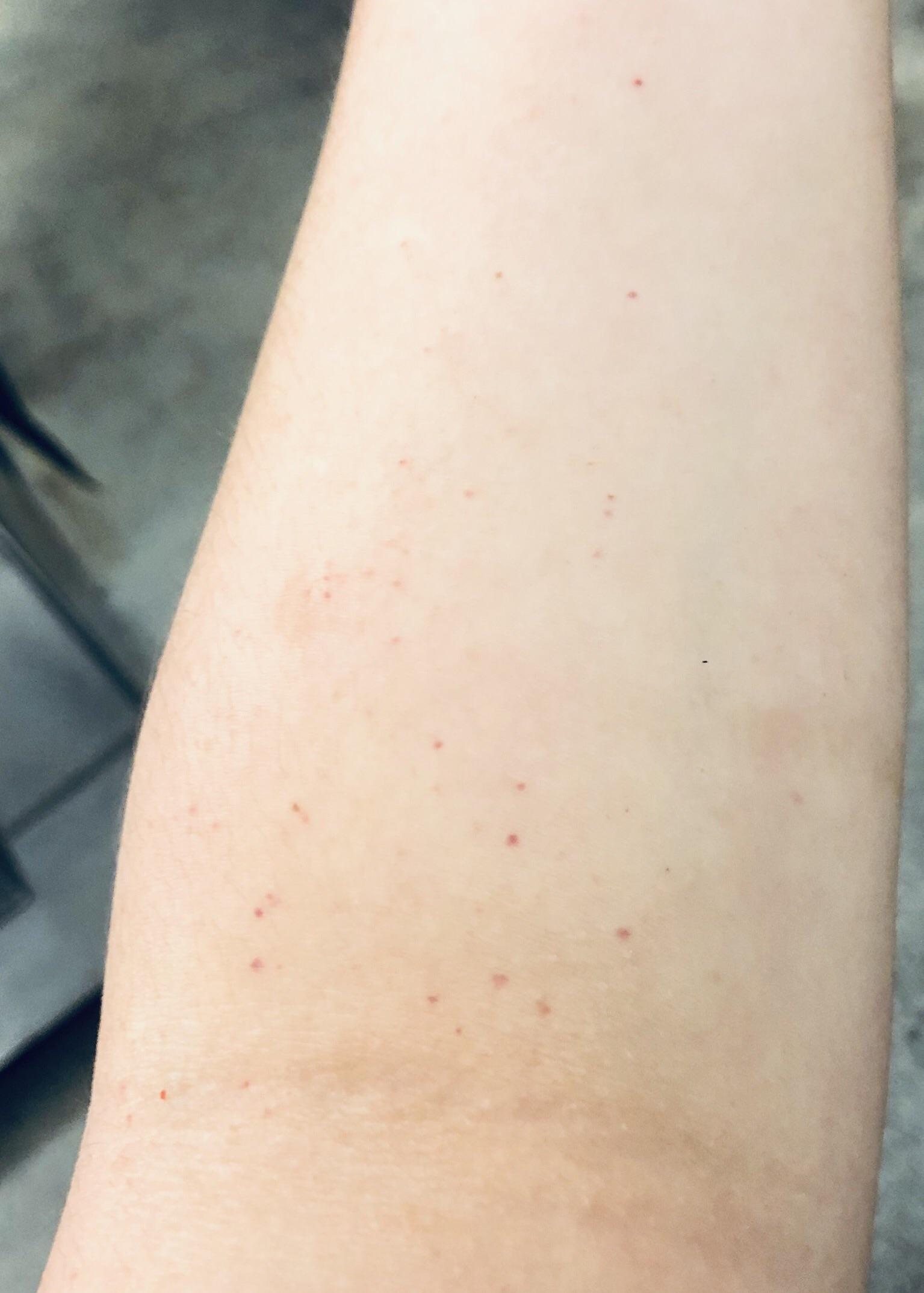 Theyre like blood freckles. Not itchy or raised r/DiagnoseMe