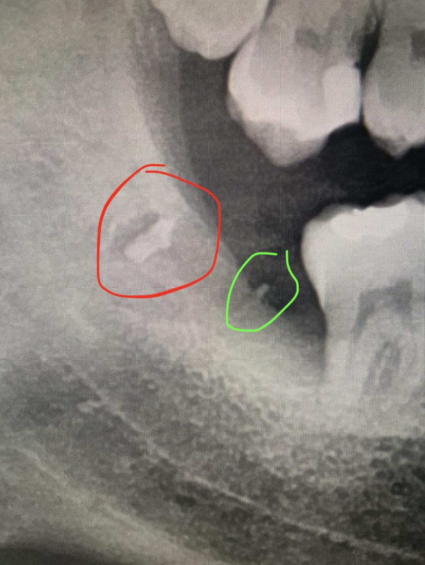 Got an xray done today since I’m 3 weeks post op of bottom two impacted