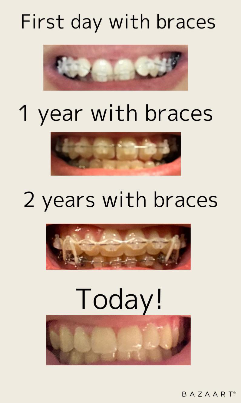 1681 best r/braces images on Pholder November 2010 vs March 2020 4