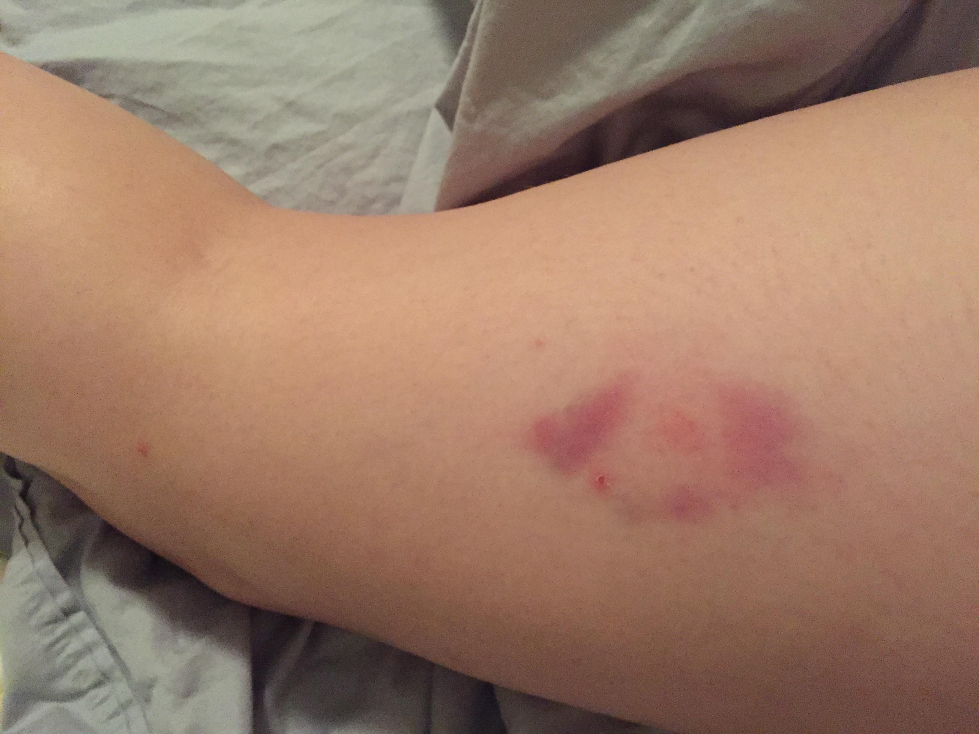 I thought it was a mosquito bite, now this bruise is around it. Any