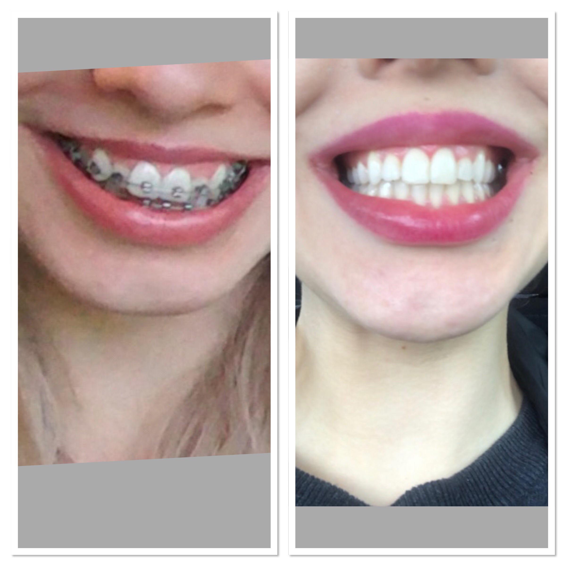 Got my braces off today! I feel amazing r/braces