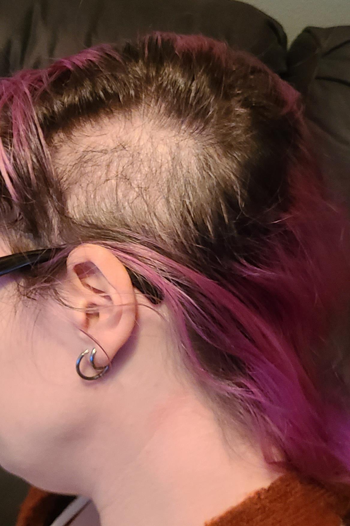 Head Covers for Shaved Head? r/trichotillomania