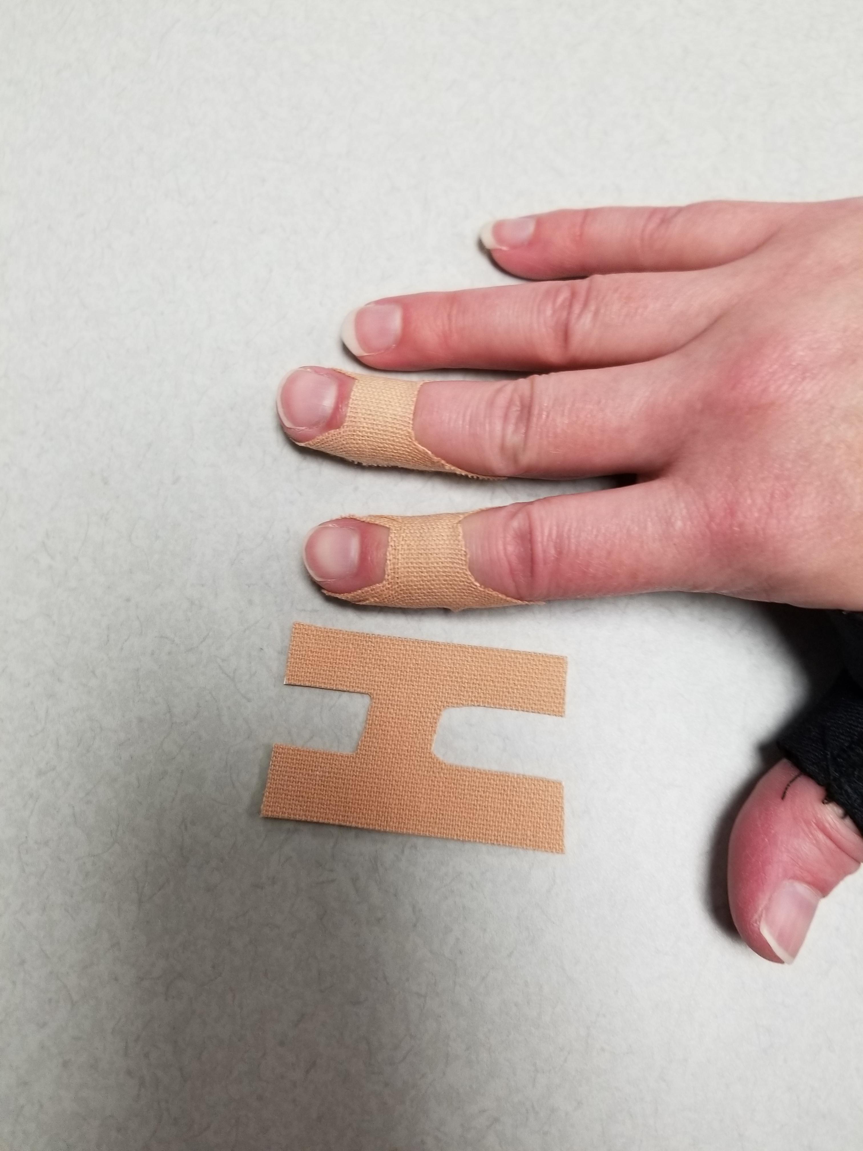 Accidentally hyperextended my knee walking down the stairs Hypermobility