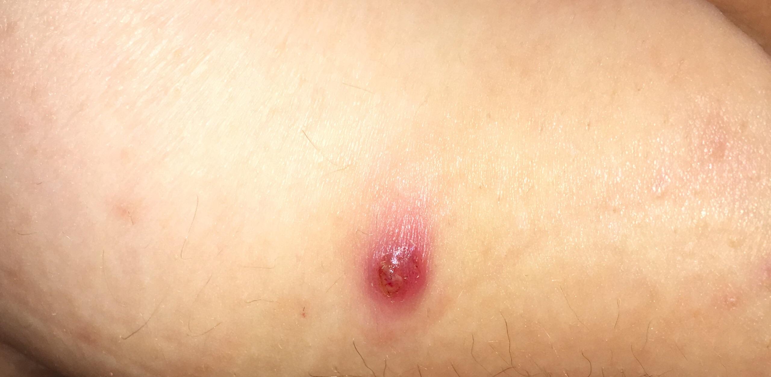 Is this a boil? Located on left butt cheek. It’s slightly painful and