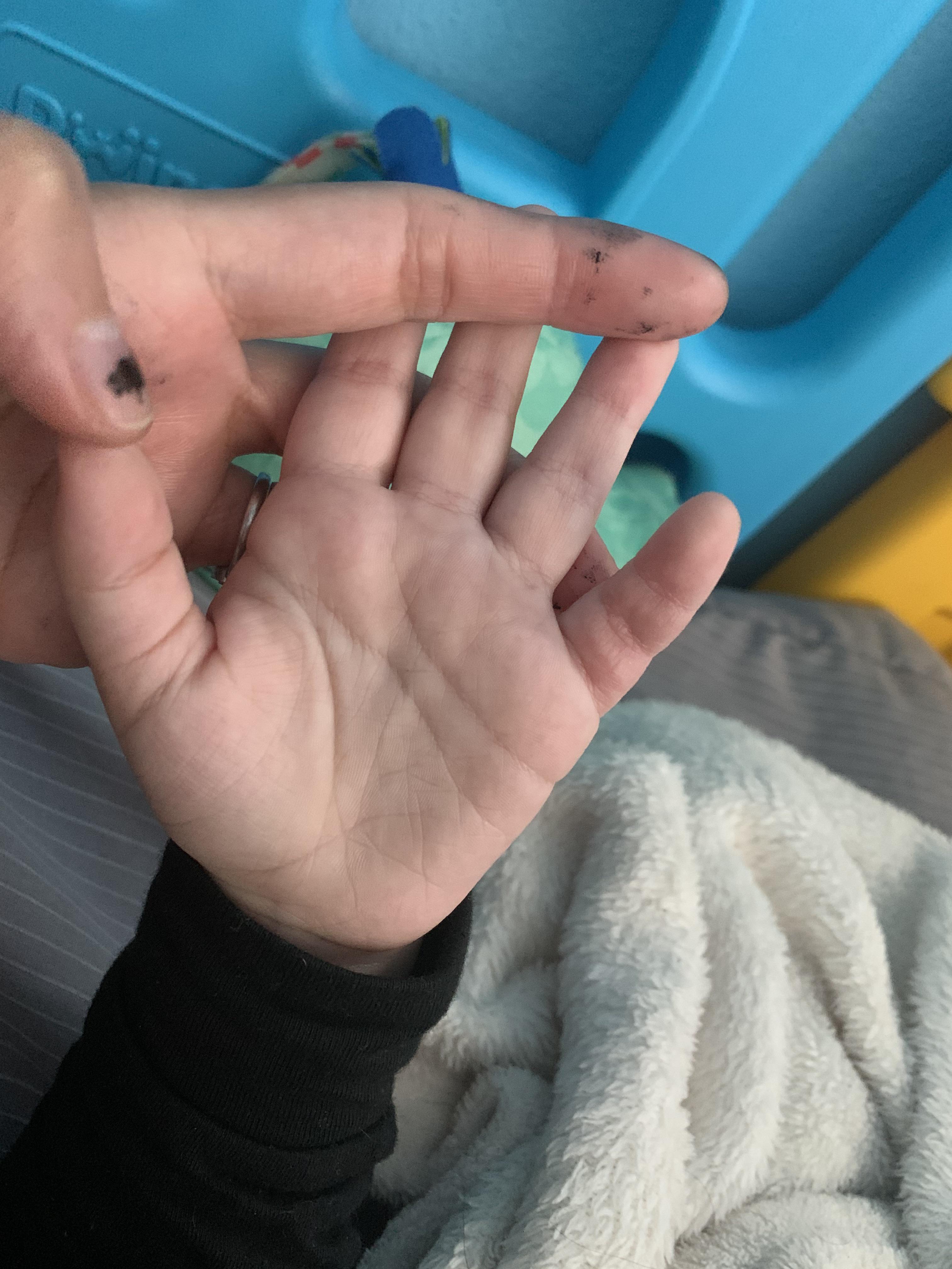 Took a picture of my toddlers hand. Anything interesting? (Black spots