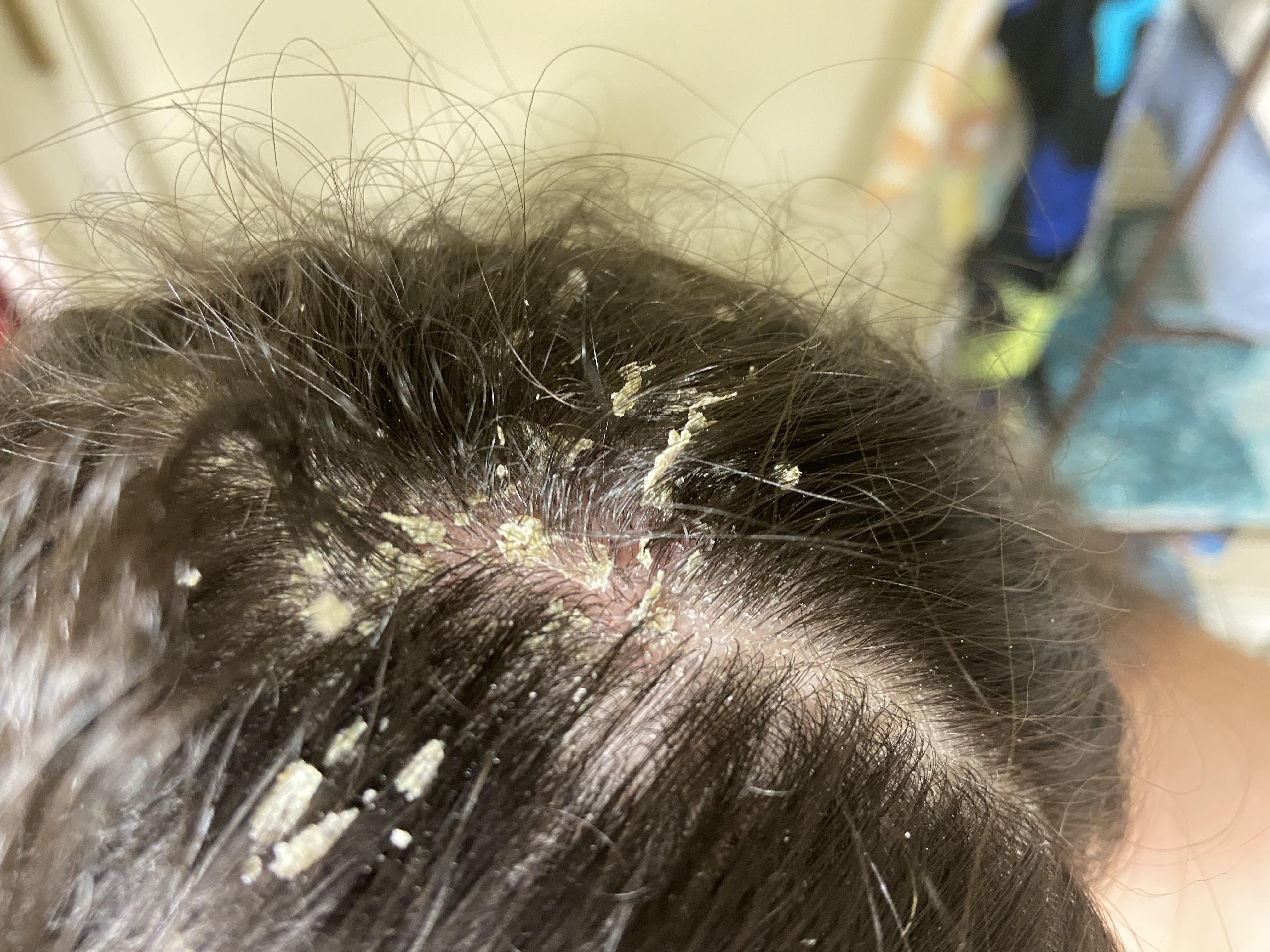 205 best r/dandruff images on Pholder I did not realize how severe my