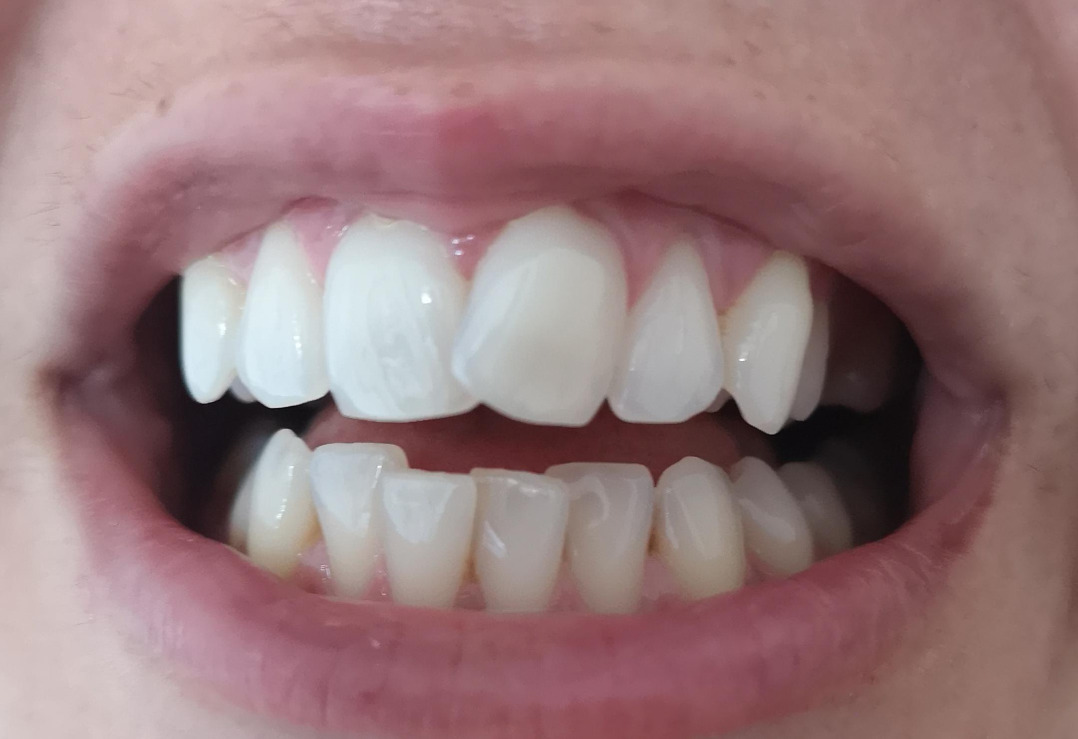 Would you me to use SDC? I've had the scan which showed