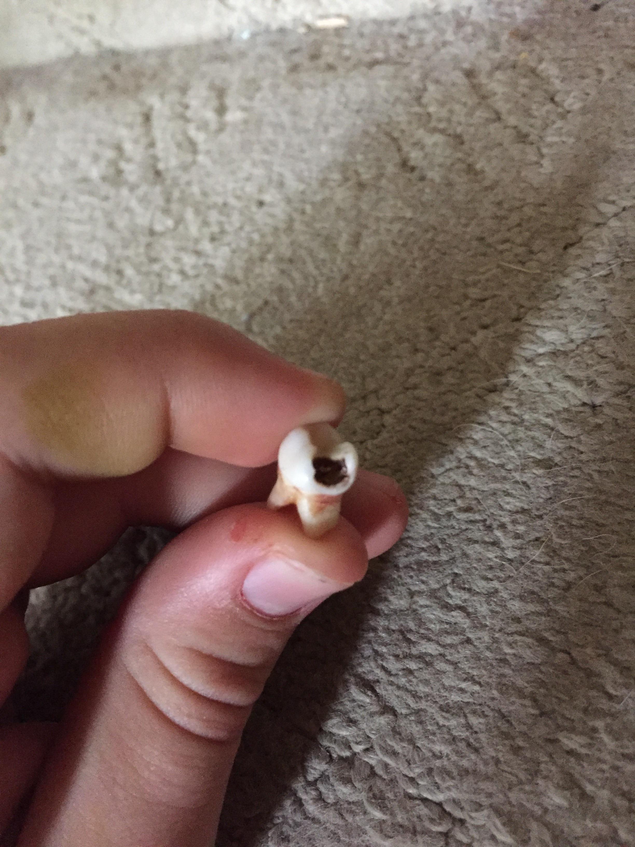 How Long Does It Take To Fill A Cavity Reddit Tooth Sensitivity Weeks