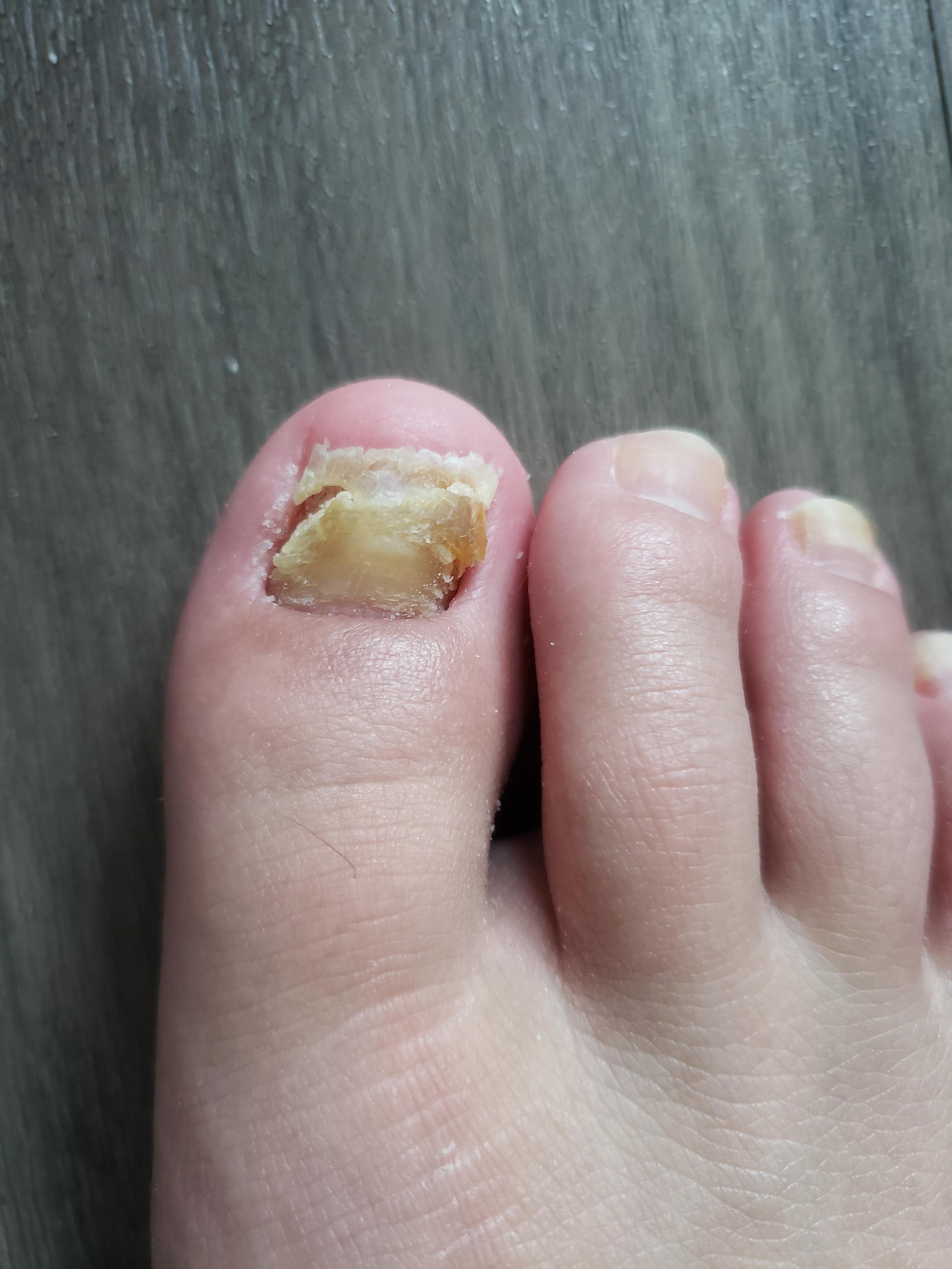 Persistent nail fungus on right toe which I started treating. Looks