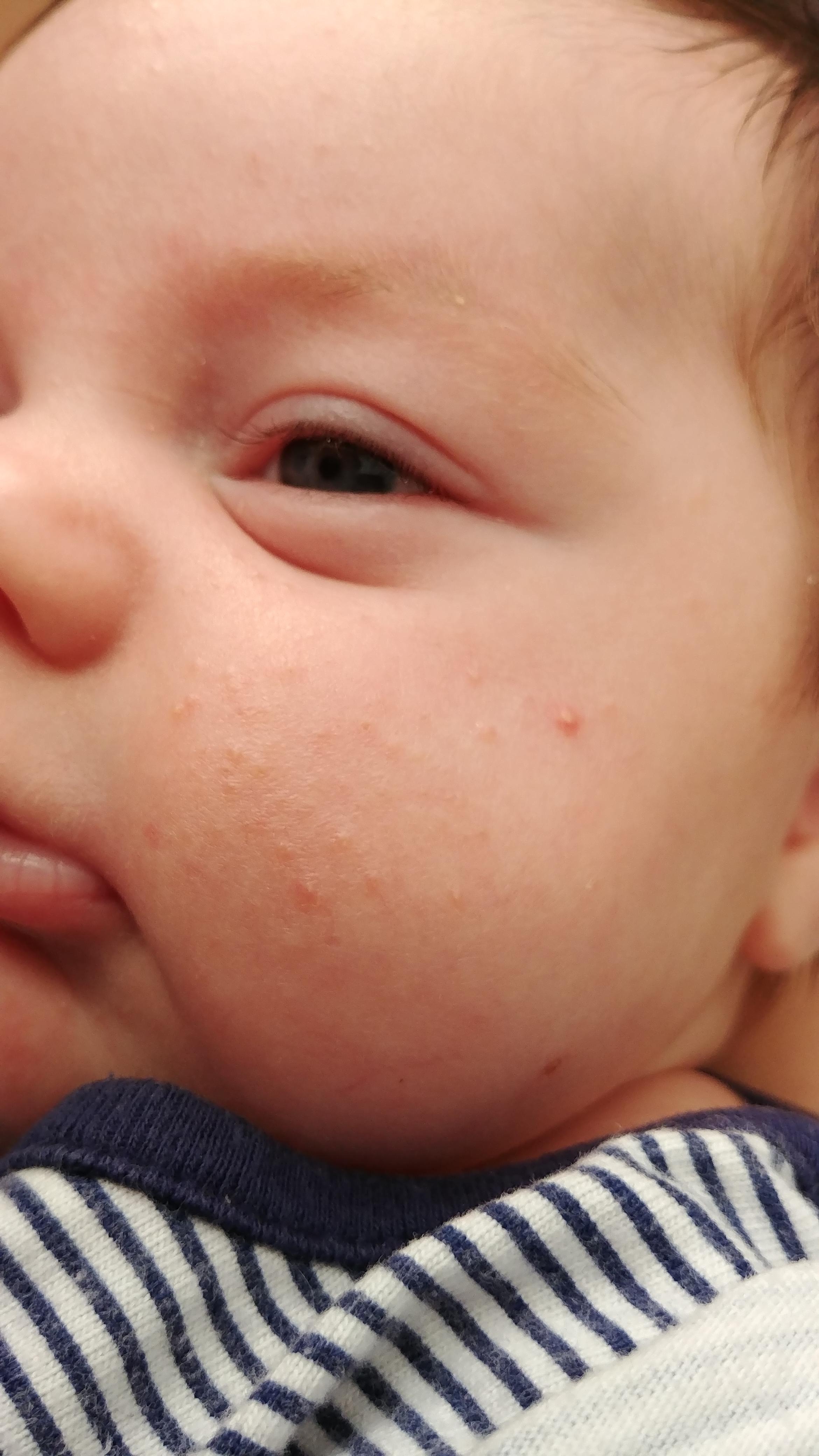 The Forbidden Squeeze...baby acne occurs in about 20 of infants