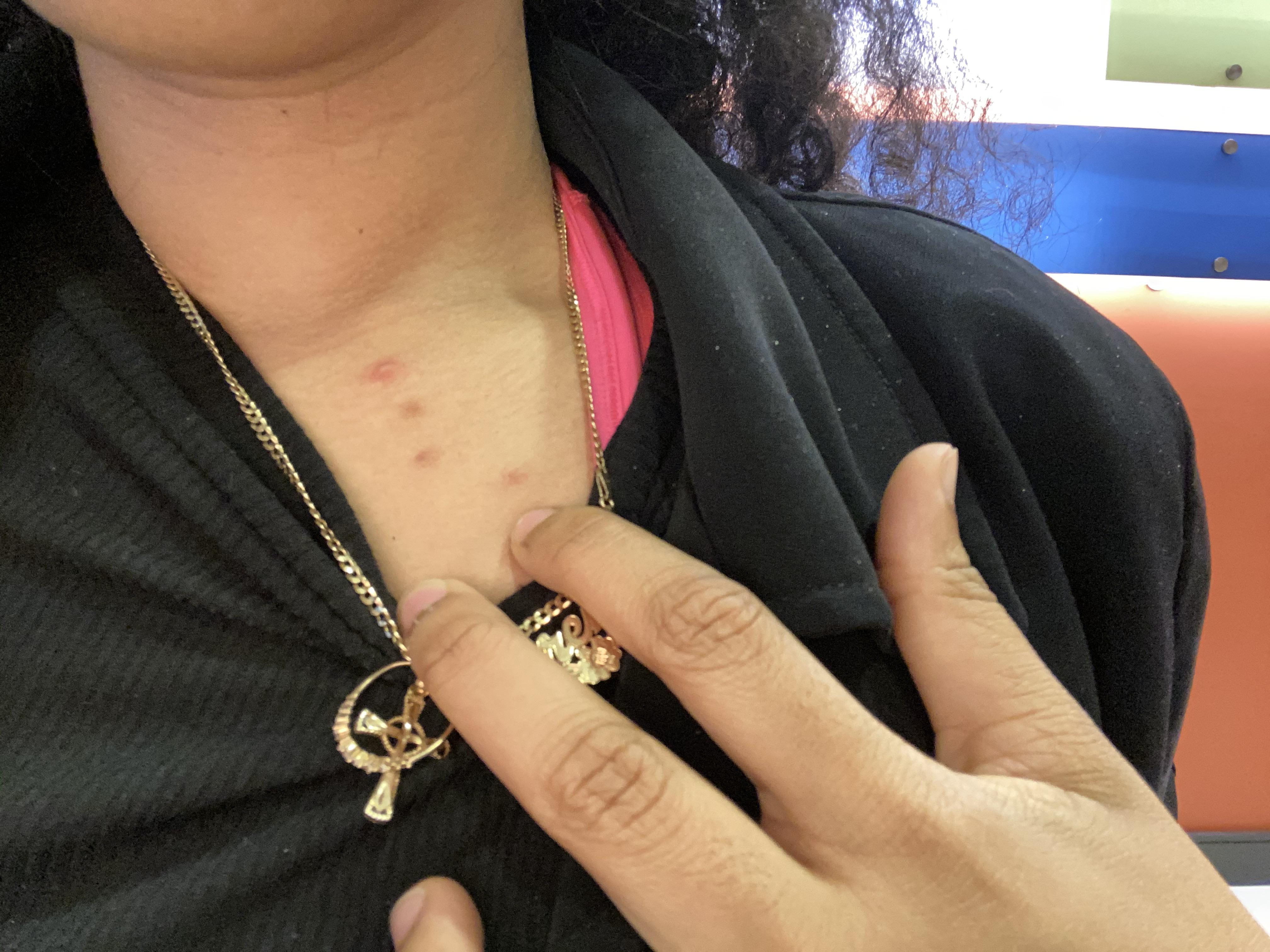 [Acne] Dealing with recurring acne on chest, the last three are just scars and the first one