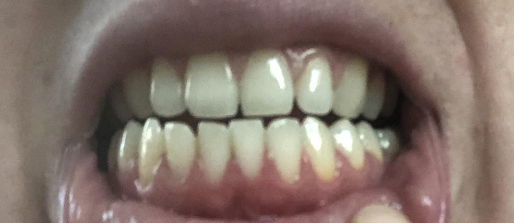 36F Are my bottom gums infected? r/medical
