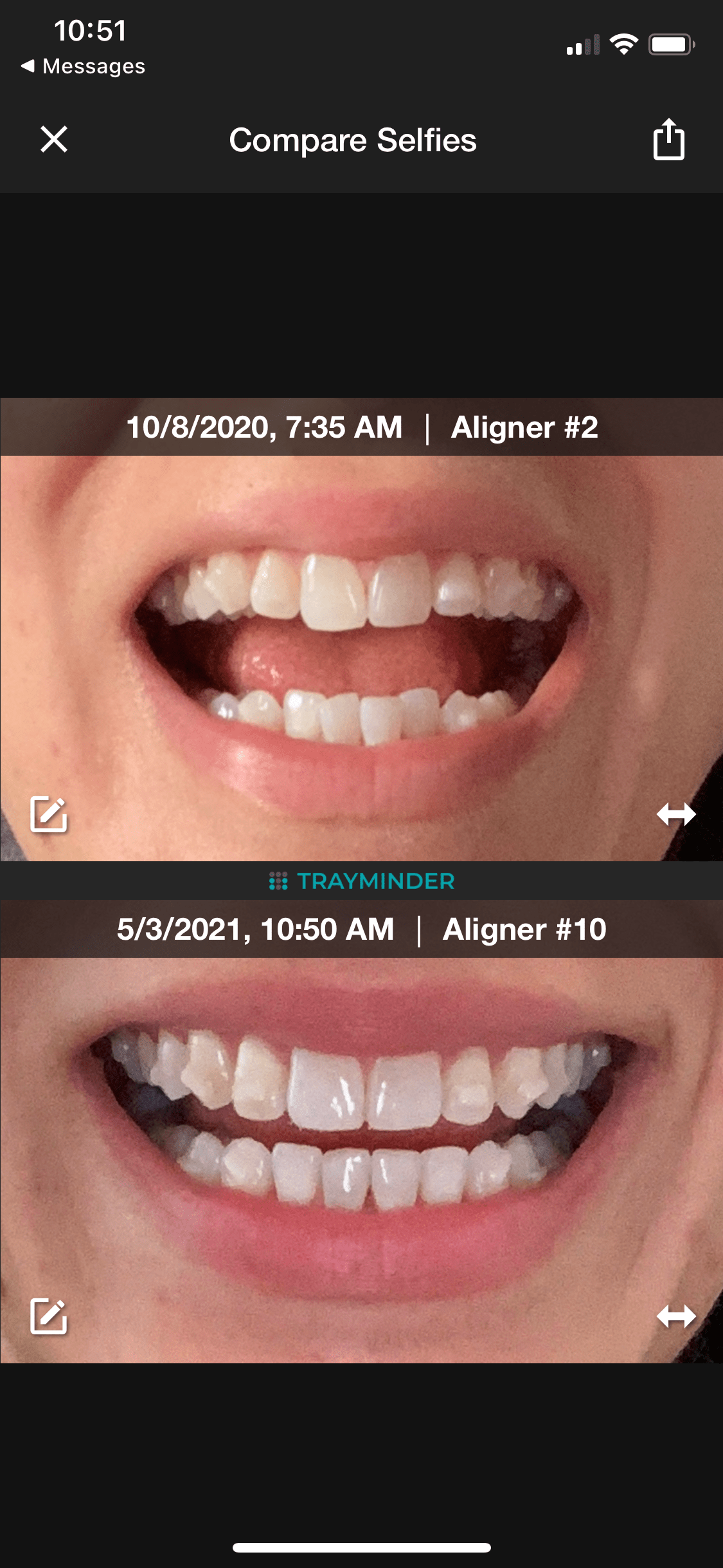 Invisalign progress! Just finished my 10 trays of refinements after my initial 21 trays. Waiting