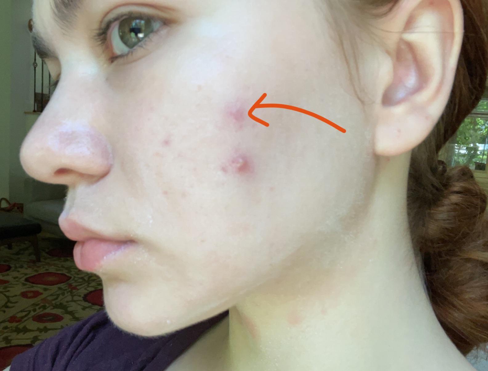 [acne] staph infection or acne? It hurts really bad but usually my acne