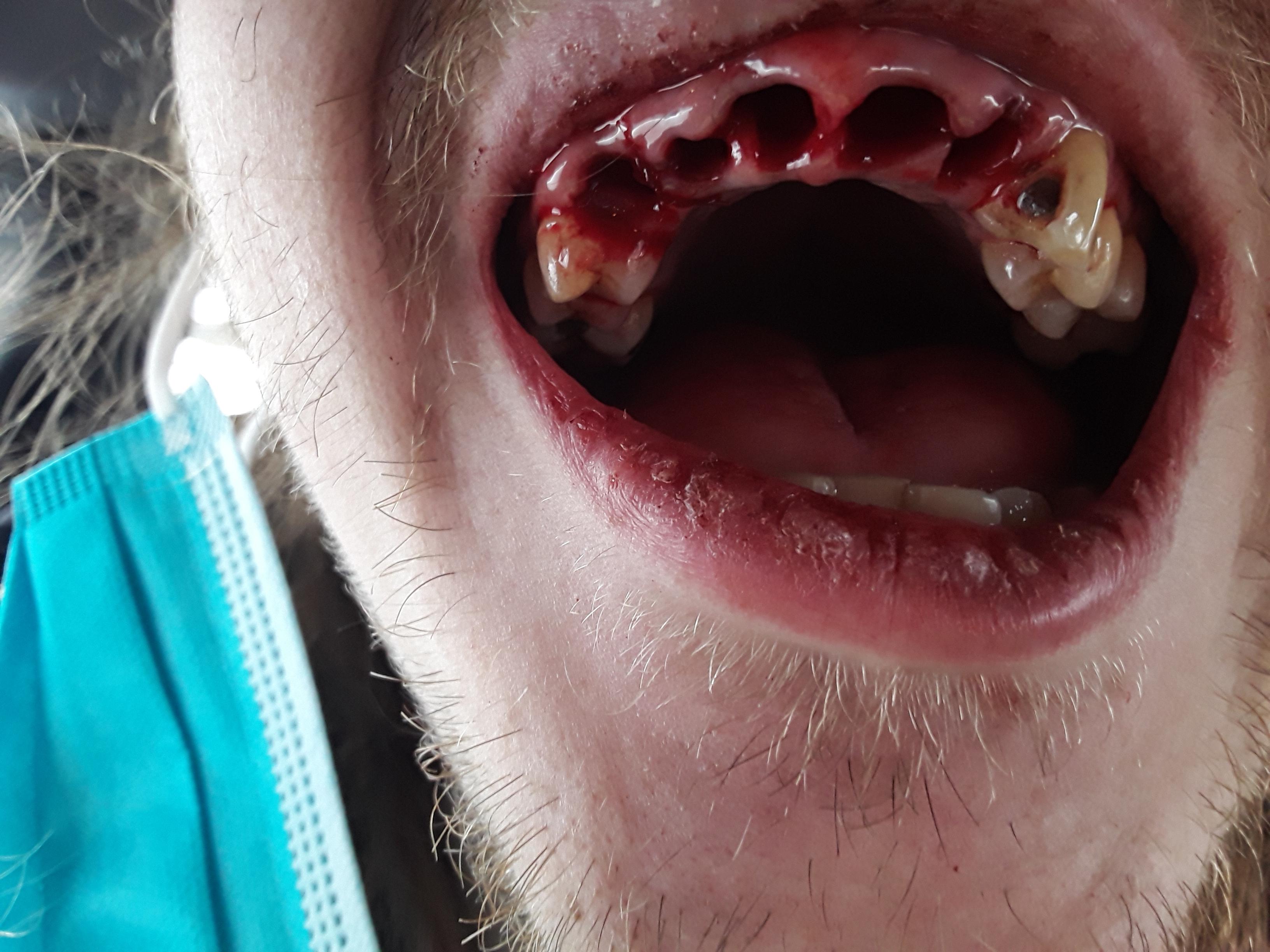 I had 12 teeth extracted thanks to a GoFundMe supported by reddit and
