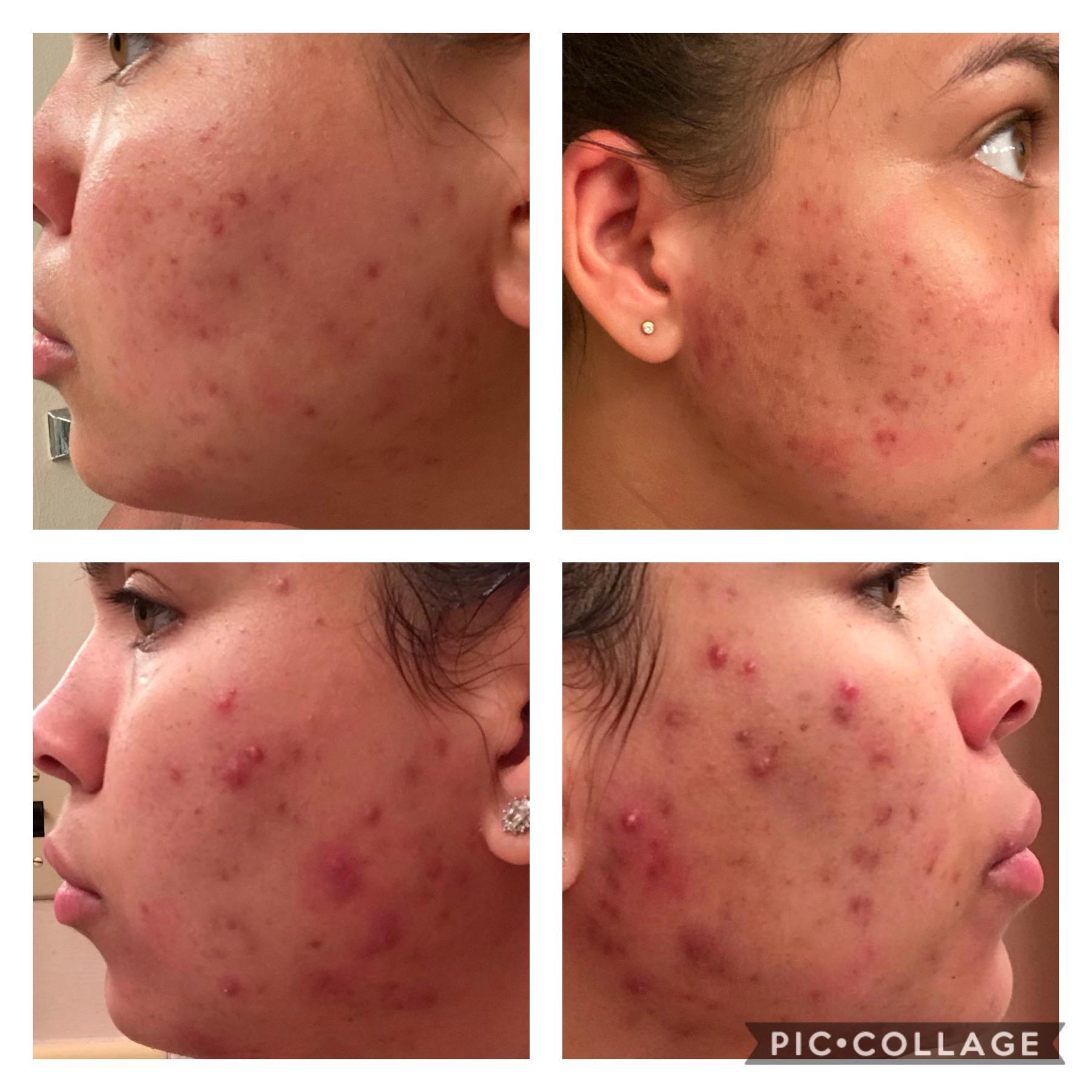 Will my acne scars disappear with topicals or should I try laser