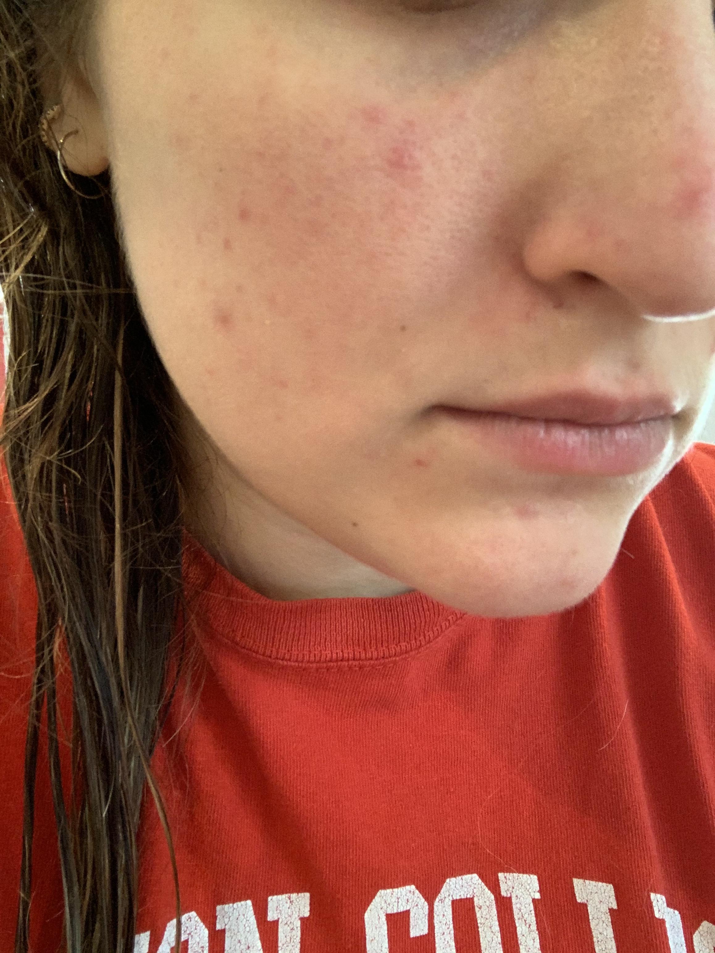 [Skin Concern] Cheek bumps/redness. r/SkincareAddiction
