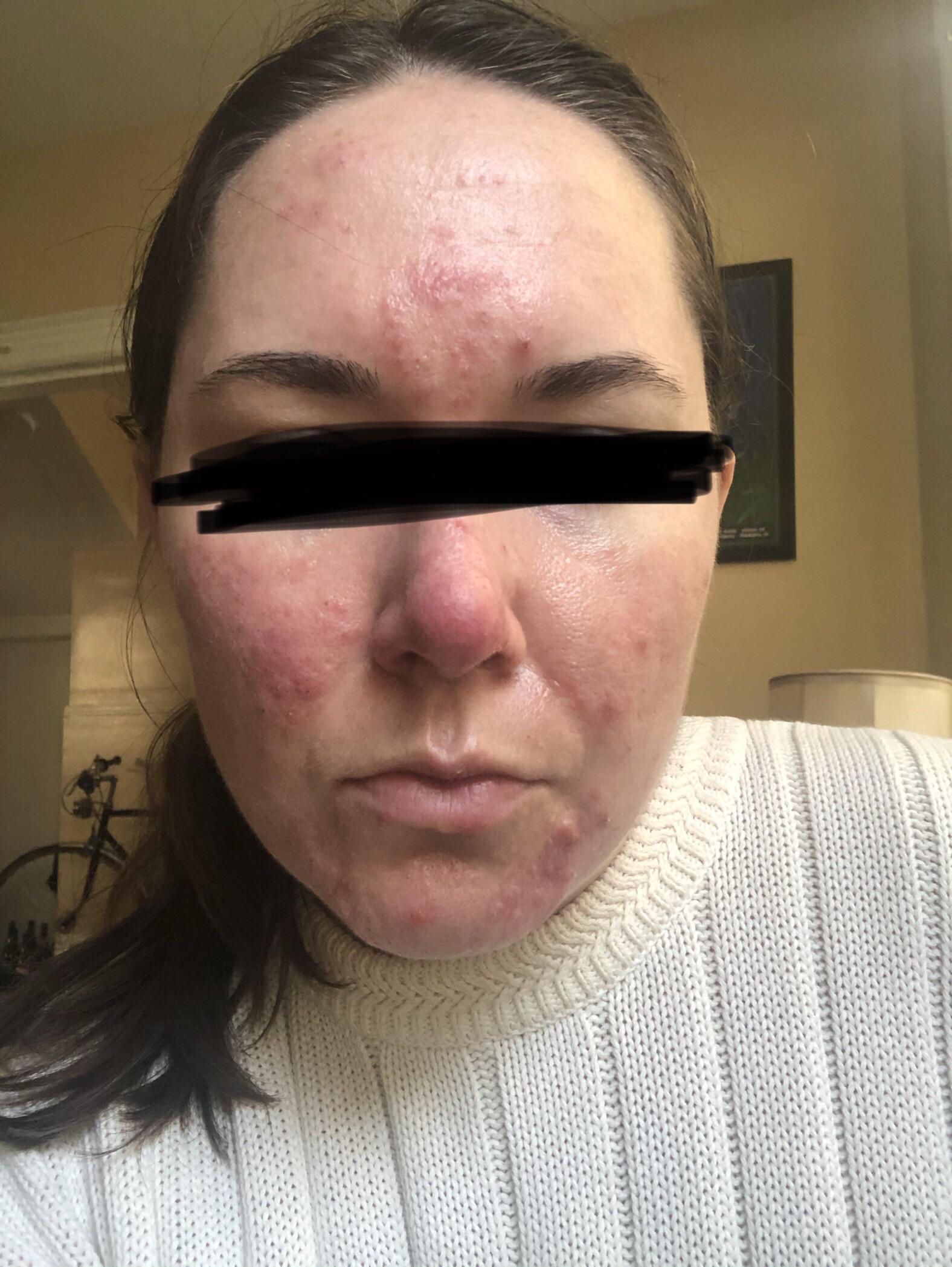 MOISTURIZER LRP cicaplast or Avene Cialfate? This is tret 0.025 week 6
