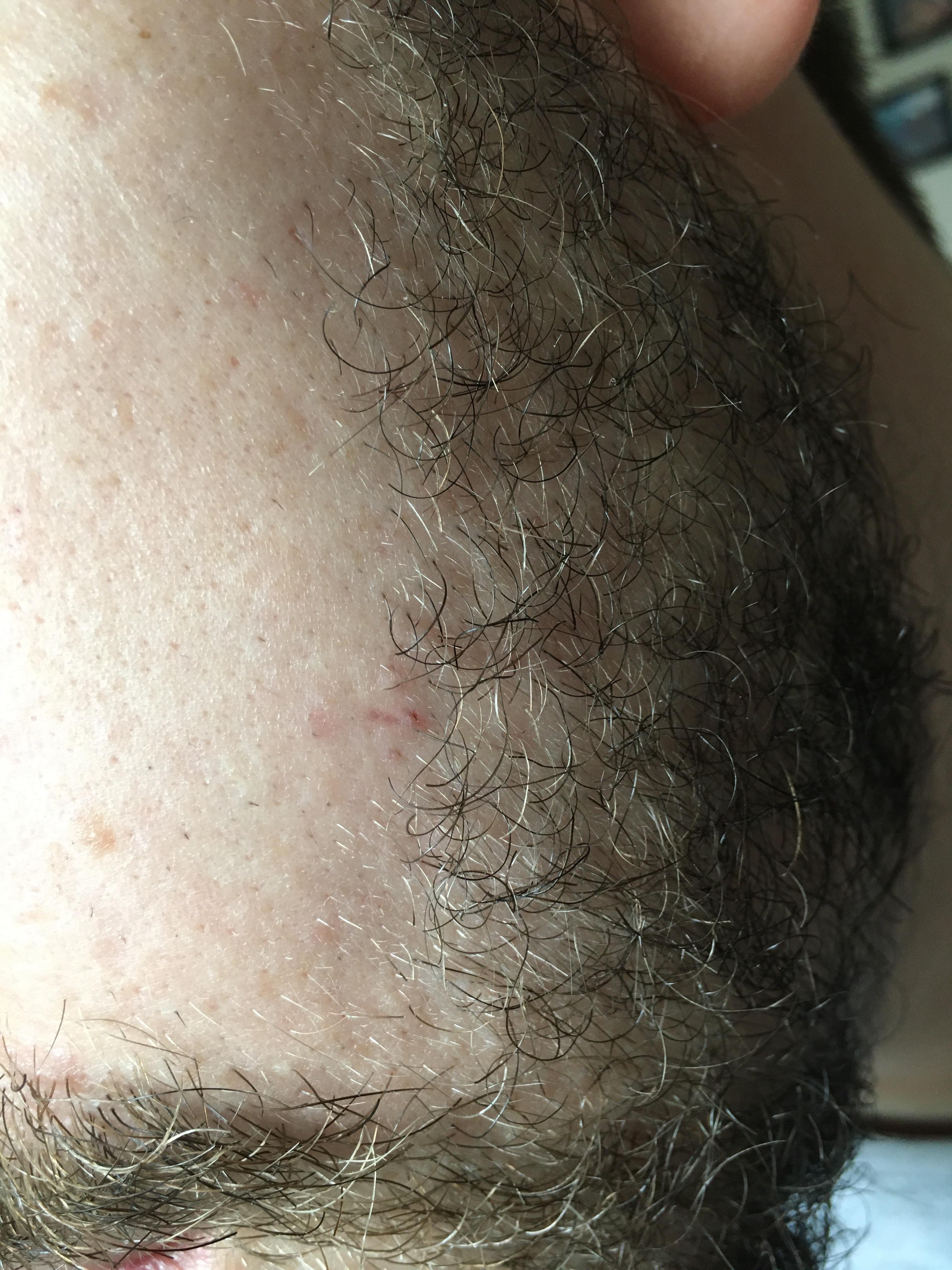 Ingrown hairs above beard line r/malegrooming