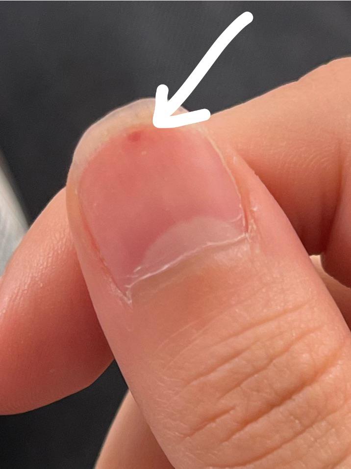 yesterday, accidentally poked the inside of my nail with the knife