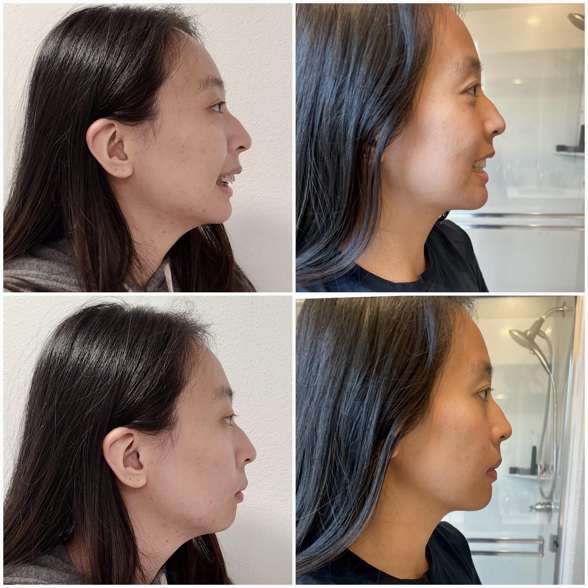 Before (left) and after (right) Double Jaw Surgery Post Op 6 months r