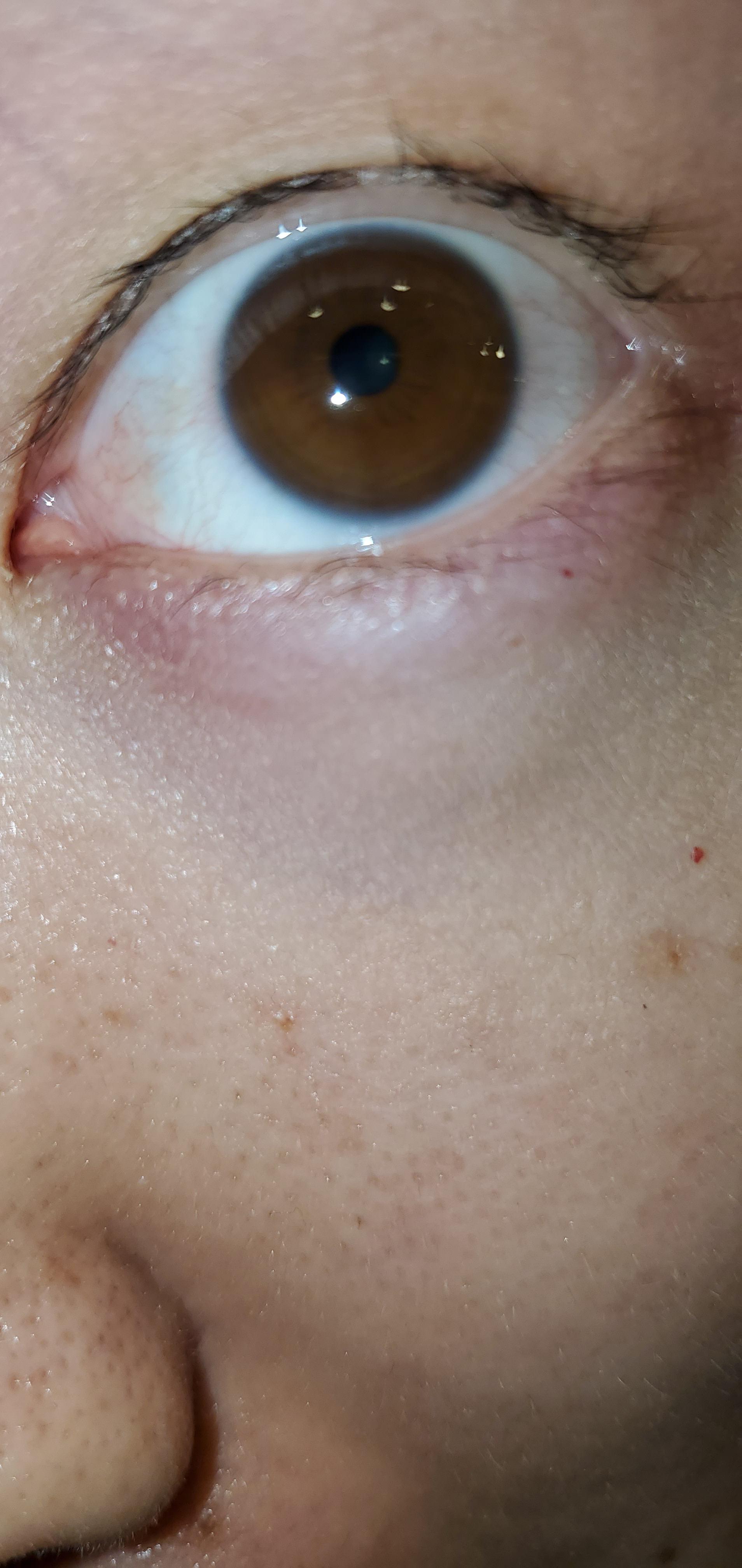 Blue sclera? r/optometry